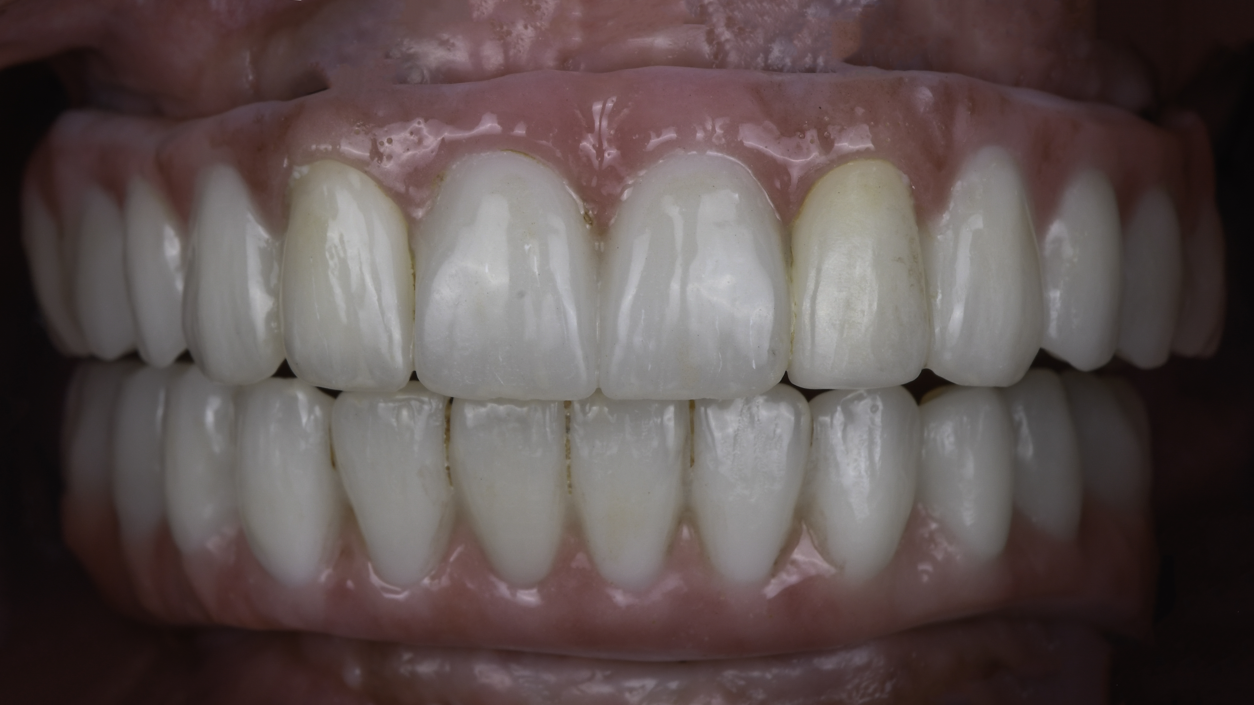 Retracted view — Full-arch implant before and after, Failing dentition replaced with fixed full-arch implant teeth, Washington, DC — after treatment