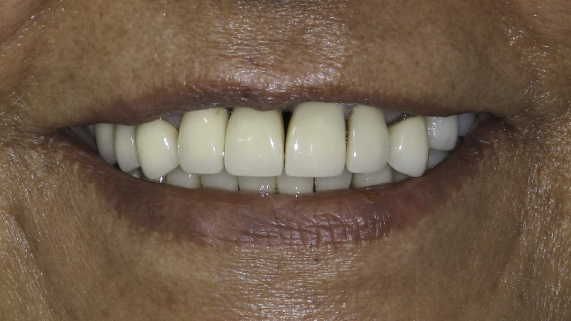 Smile makeover before and after — Worn, mismatched restorations rebuilt in a full-mouth rehabilitation, treated by Dr. Kambez Shukoor in Washington, DC — before treatment
