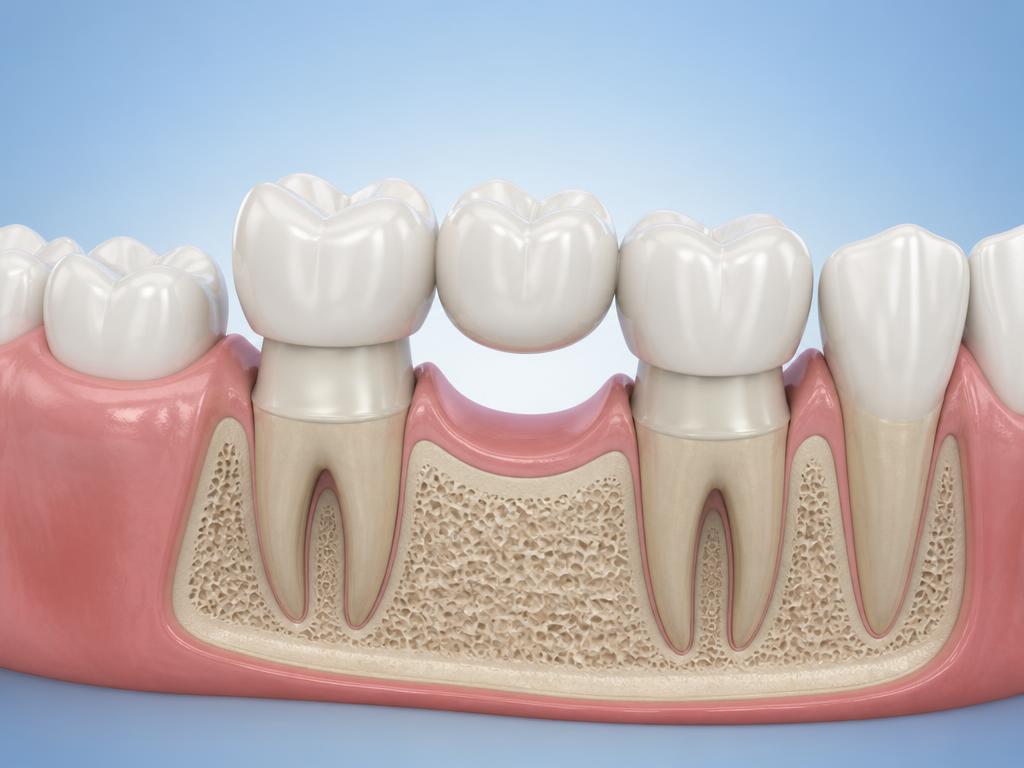 Cross-section illustration of a traditional dental bridge — two crowned anchor teeth supporting a false tooth (pontic) in the gap.