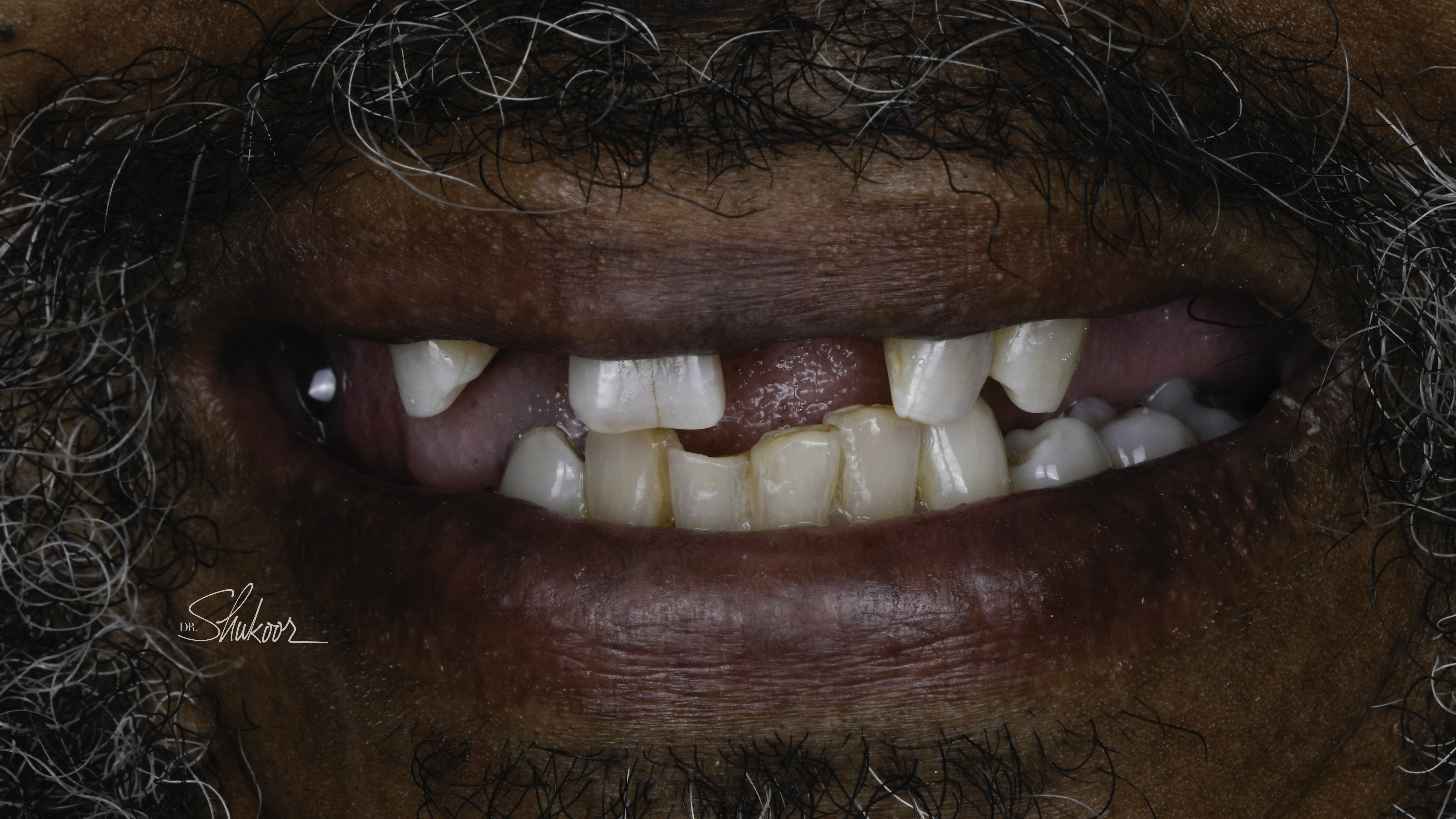 Dental Flipper case — Missing front tooth replaced immediately with a dental flipper, treated by Dr. Kambez Shukoor in Washington, DC — before treatment