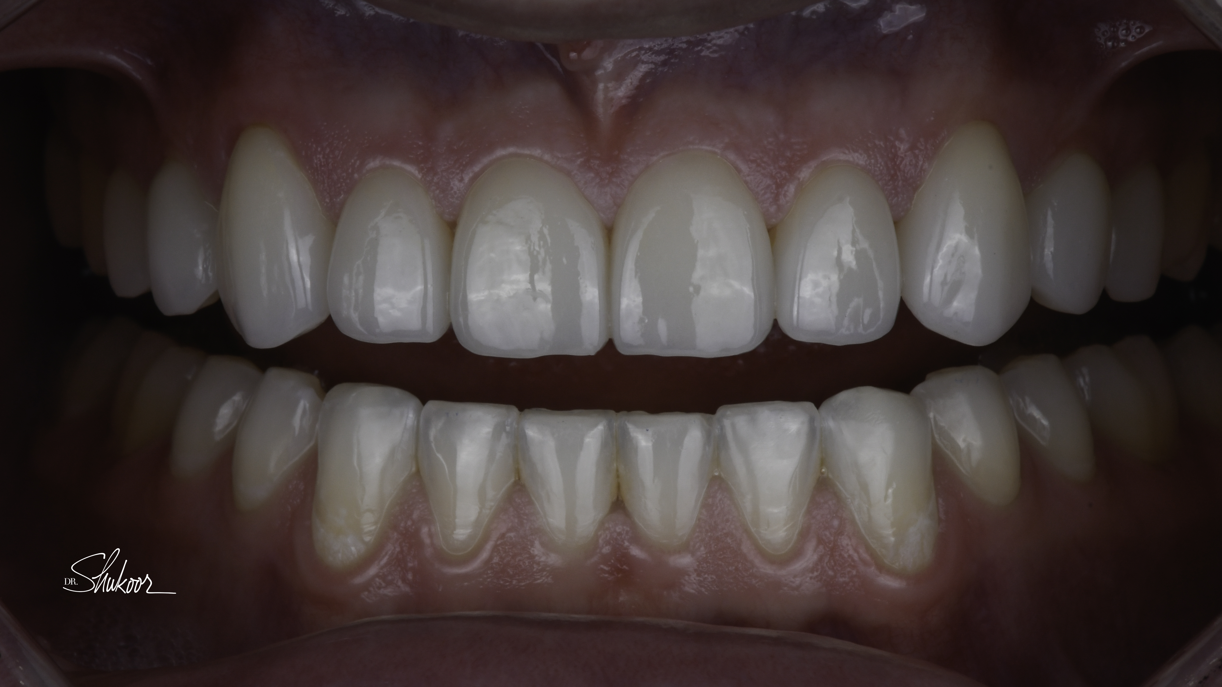 Close-up view — porcelain veneers before and after, Worn & Uneven Front Teeth Rebuilt With Porcelain Veneers, Washington, DC — after treatment