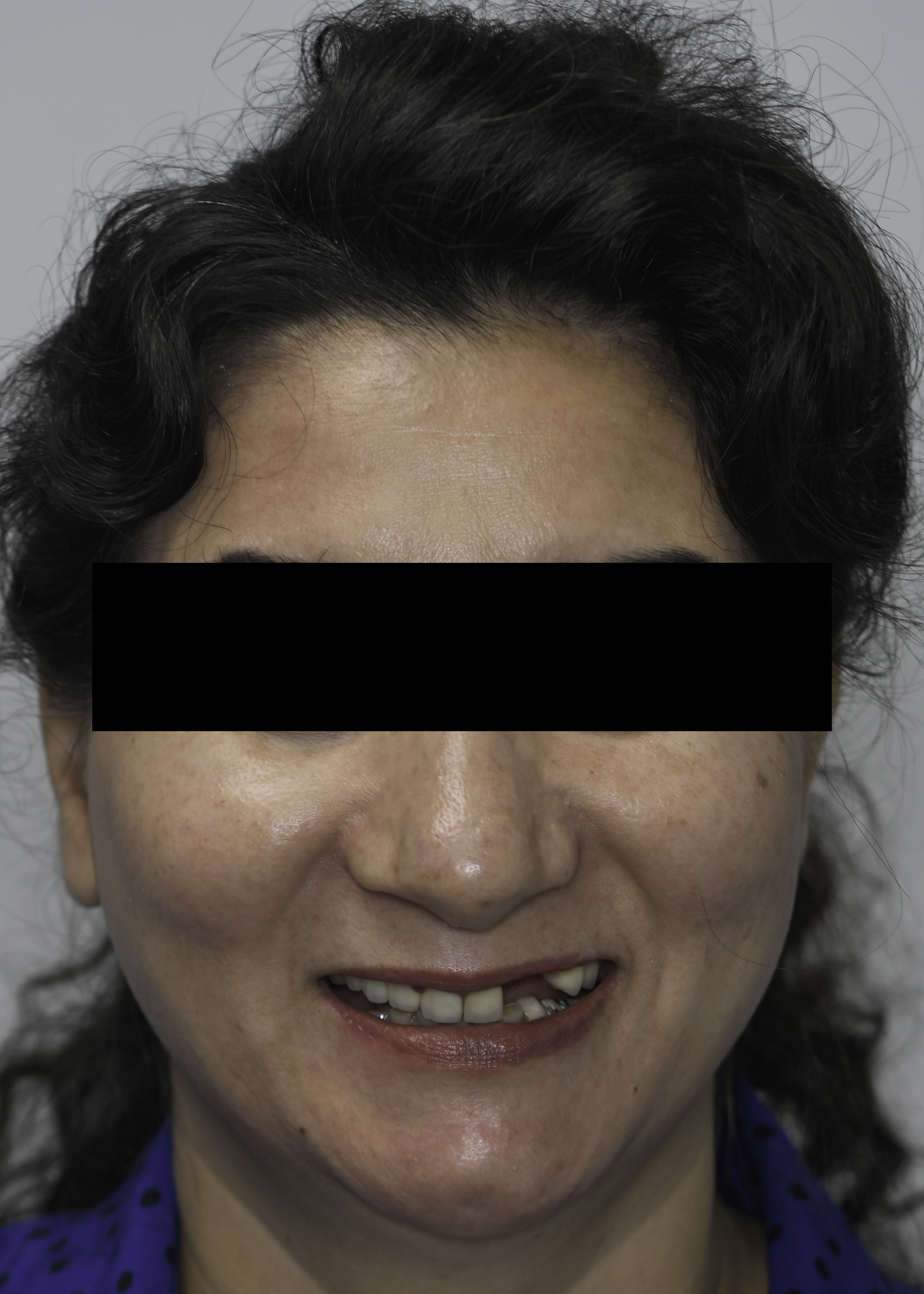 Single tooth implant before and after — Missing tooth replaced with a single dental implant and crown, treated by Dr. Kambez Shukoor in Washington, DC — before treatment