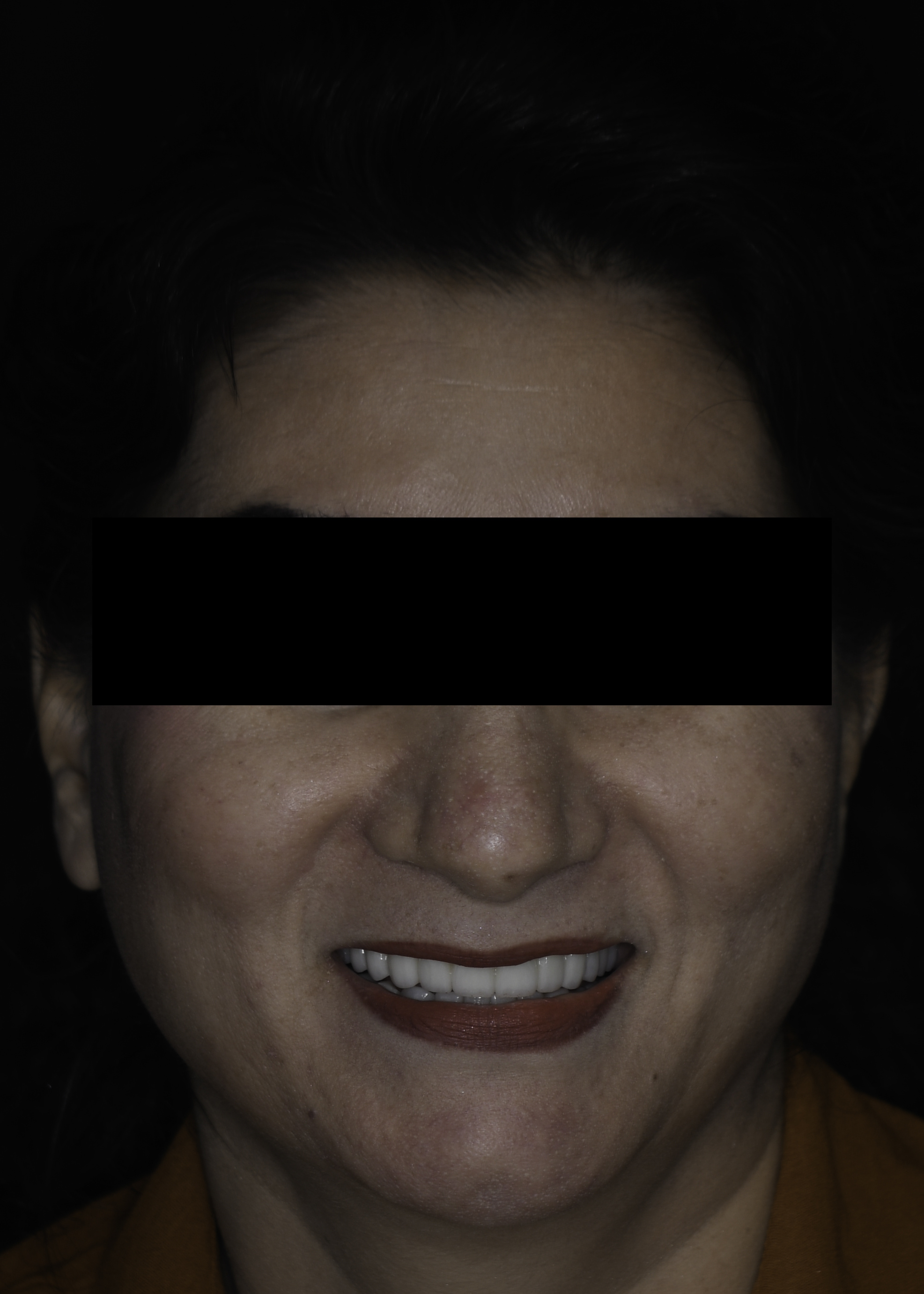 Single tooth implant before and after — Missing tooth replaced with a single dental implant and crown, treated by Dr. Kambez Shukoor in Washington, DC — after treatment