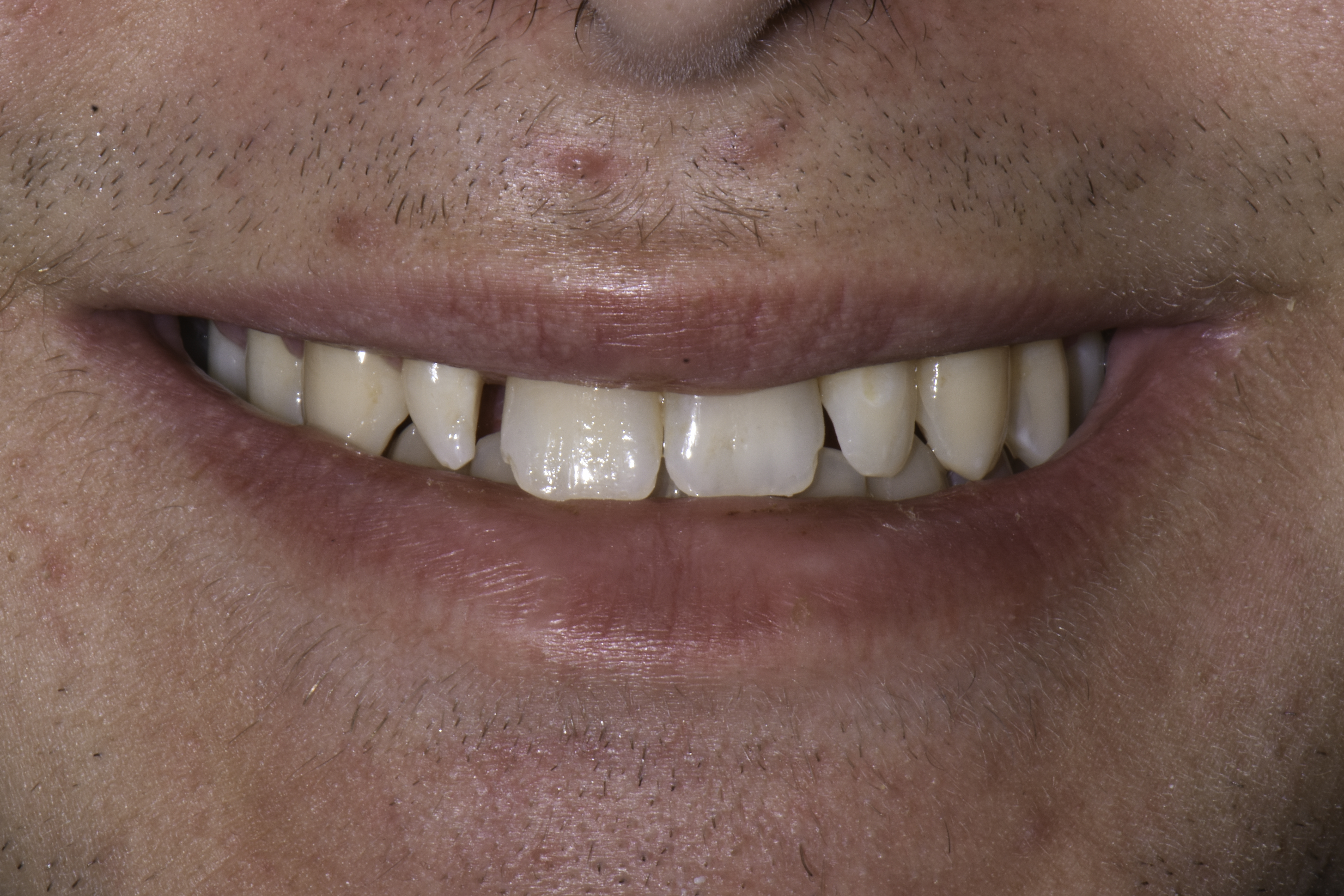 Porcelain veneers before and after — Small, uneven front teeth rebuilt with porcelain veneers, treated by Dr. Kambez Shukoor in Washington, DC — before treatment