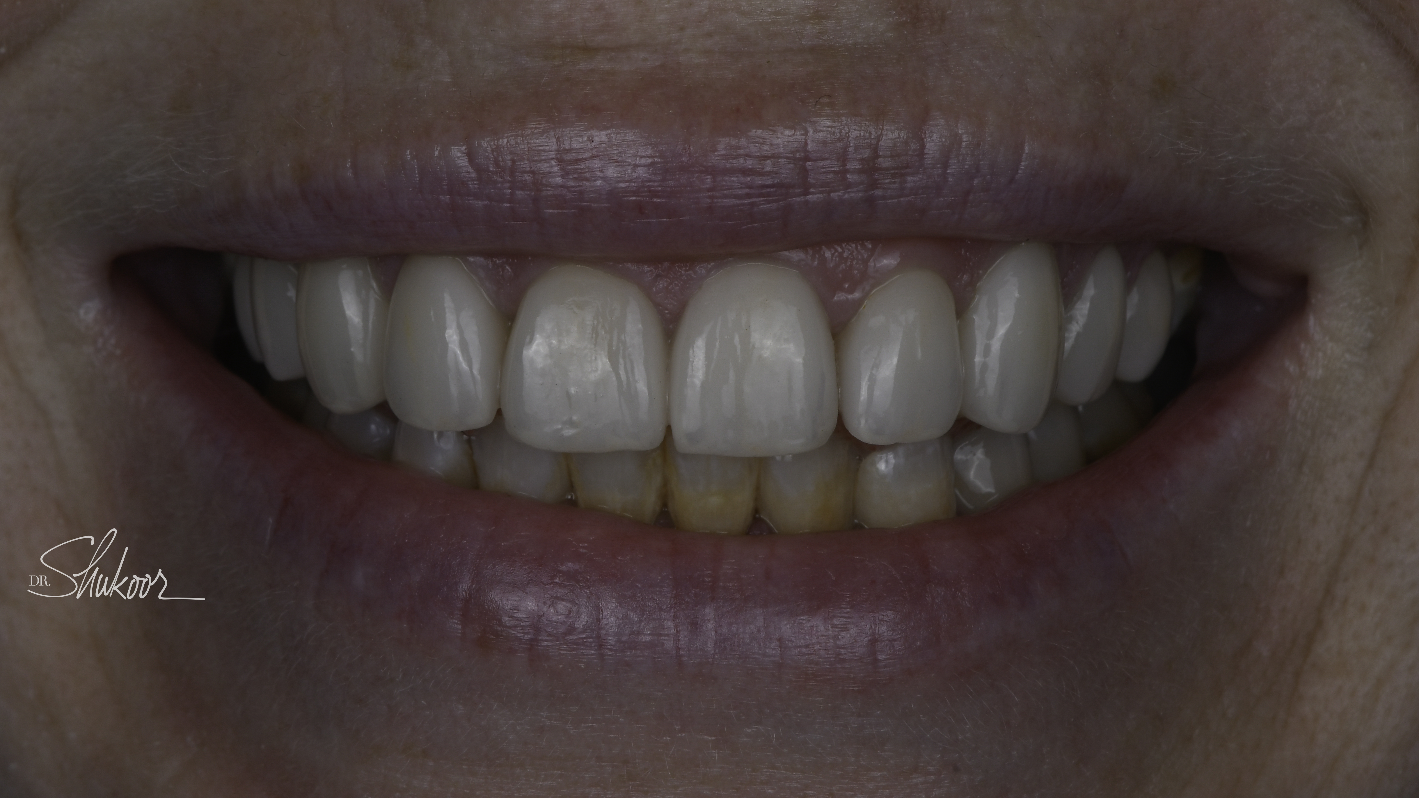 Porcelain veneers before and after — Stained, Chipped Teeth Transformed With Porcelain Veneers, treated by Dr. Kambez Shukoor in Washington, DC — after treatment