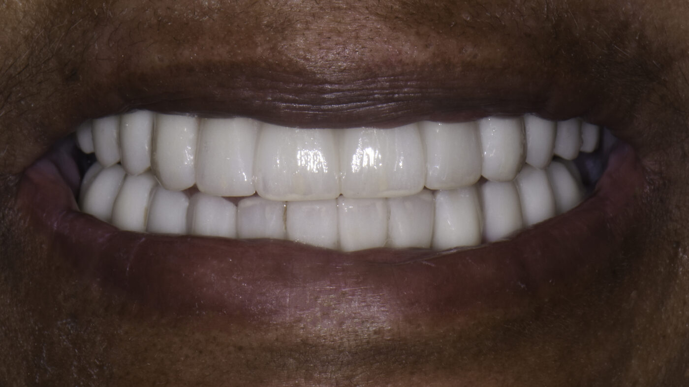 Full-Arch Implants case — Failing upper teeth replaced with a fixed implant-supported arch, treated by Dr. Kambez Shukoor in Washington, DC — after treatment