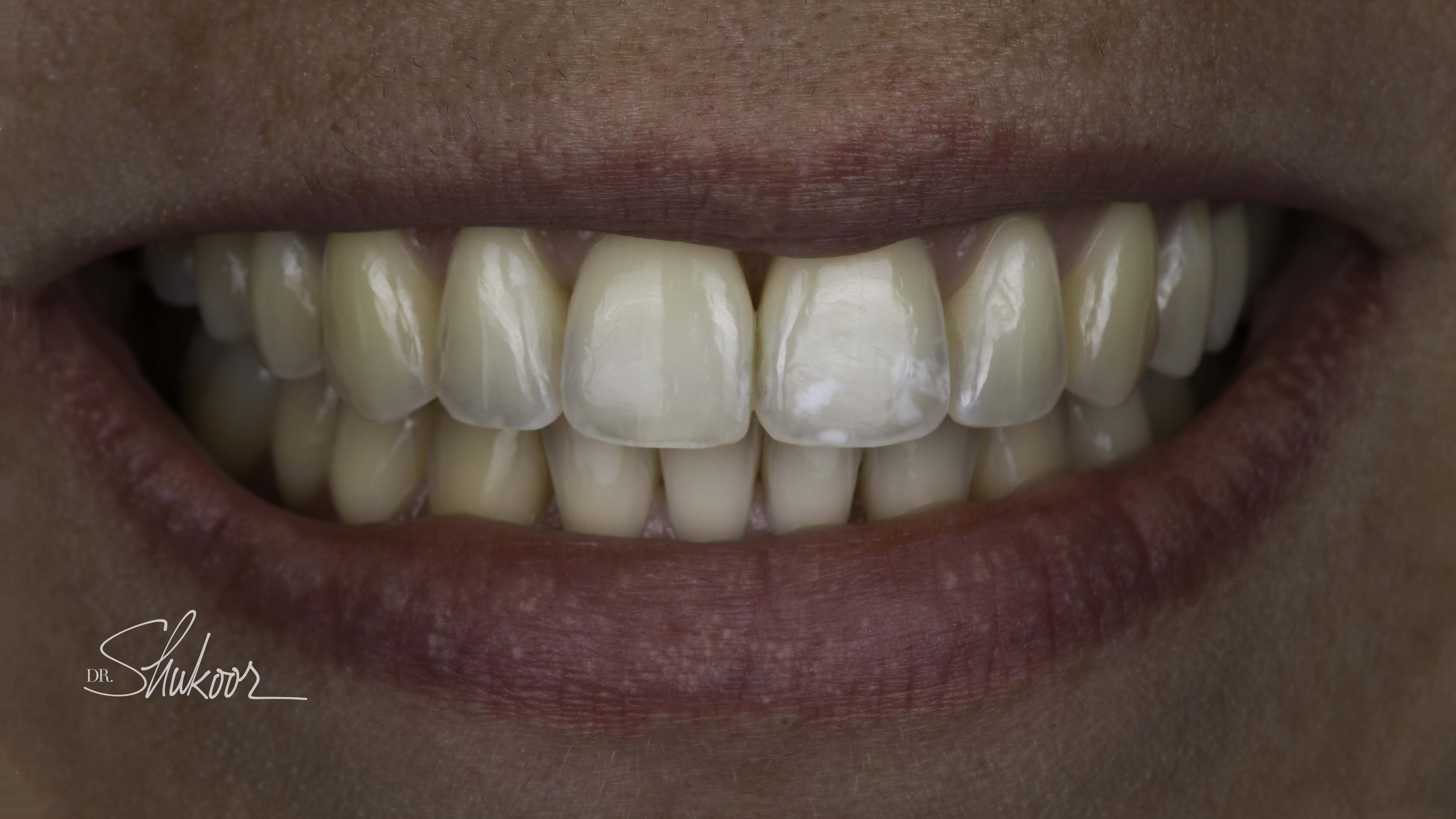 Clear aligners before and after — Worn, uneven incisal edges realigned with clear aligners, treated by Dr. Kambez Shukoor in Washington, DC — after treatment