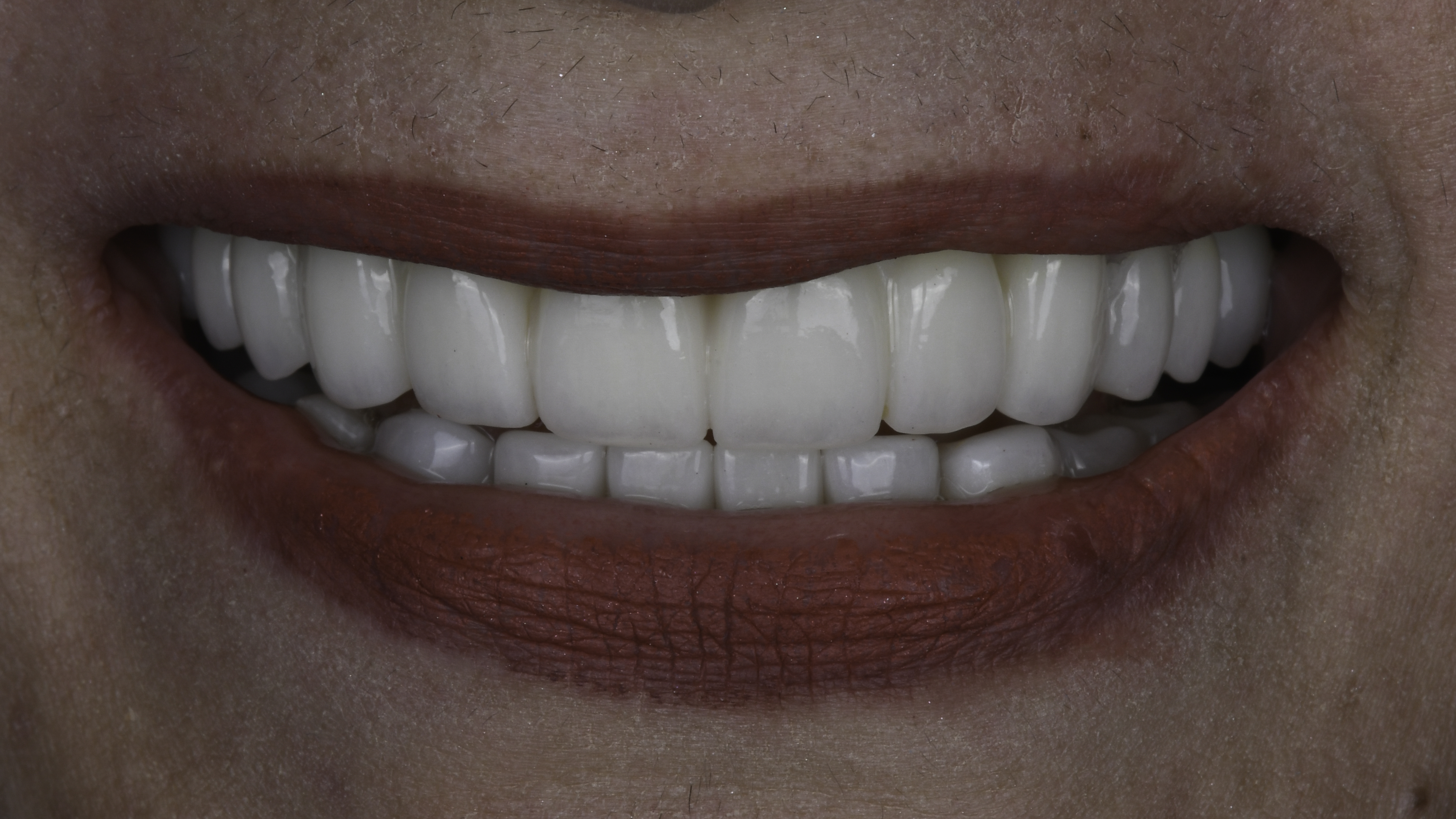 Close-up view — Single tooth implant before and after, Missing tooth replaced with a single dental implant and crown, Washington, DC — after treatment