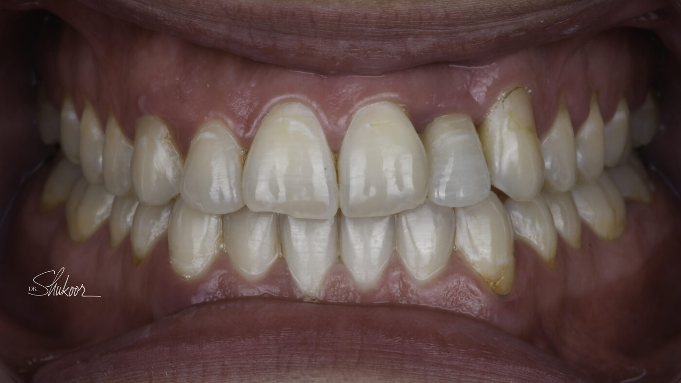 Clear Aligners case — Crowded arch expanded and leveled with clear aligners, treated by Dr. Kambez Shukoor in Washington, DC — after treatment