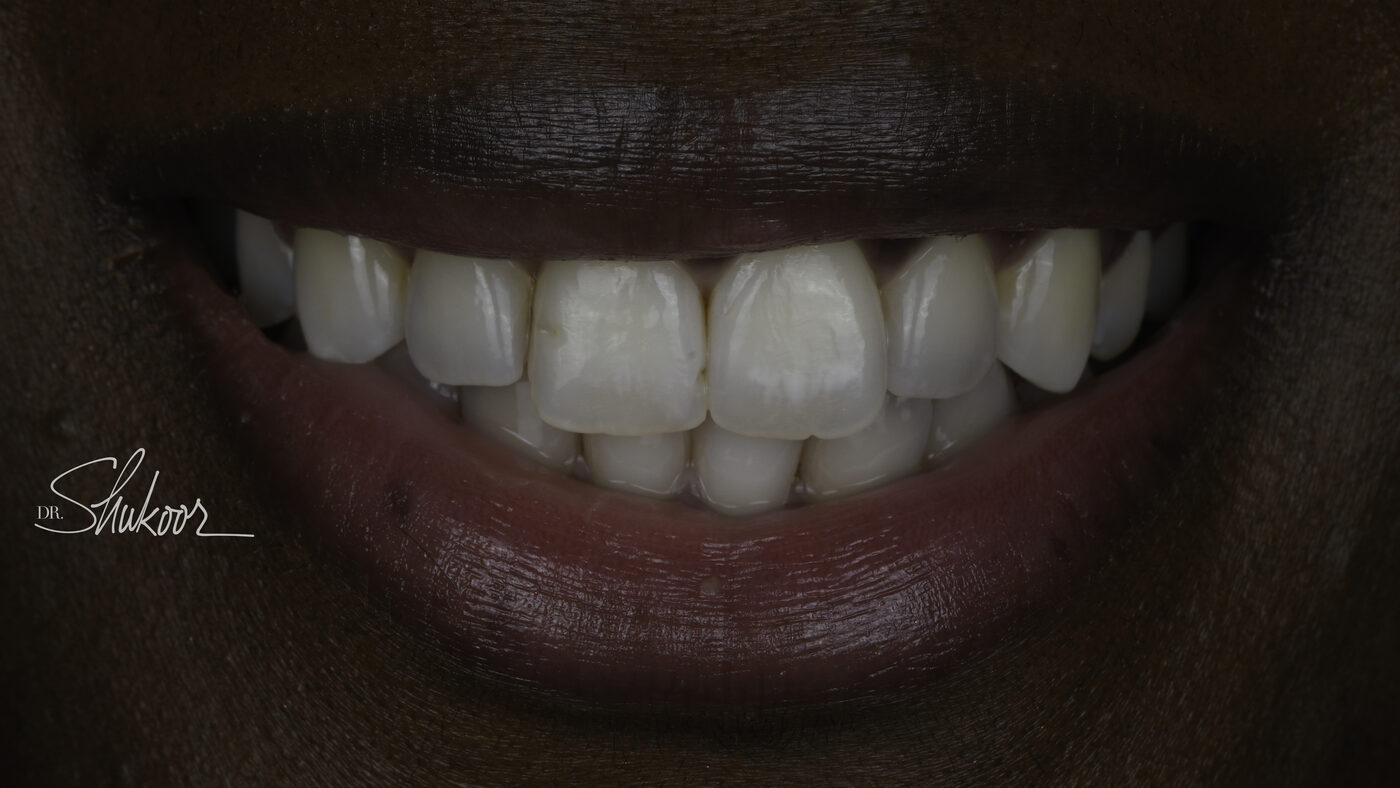 Clear Aligners case — Crowded upper and lower front teeth aligned with clear aligners, treated by Dr. Kambez Shukoor in Washington, DC — after treatment