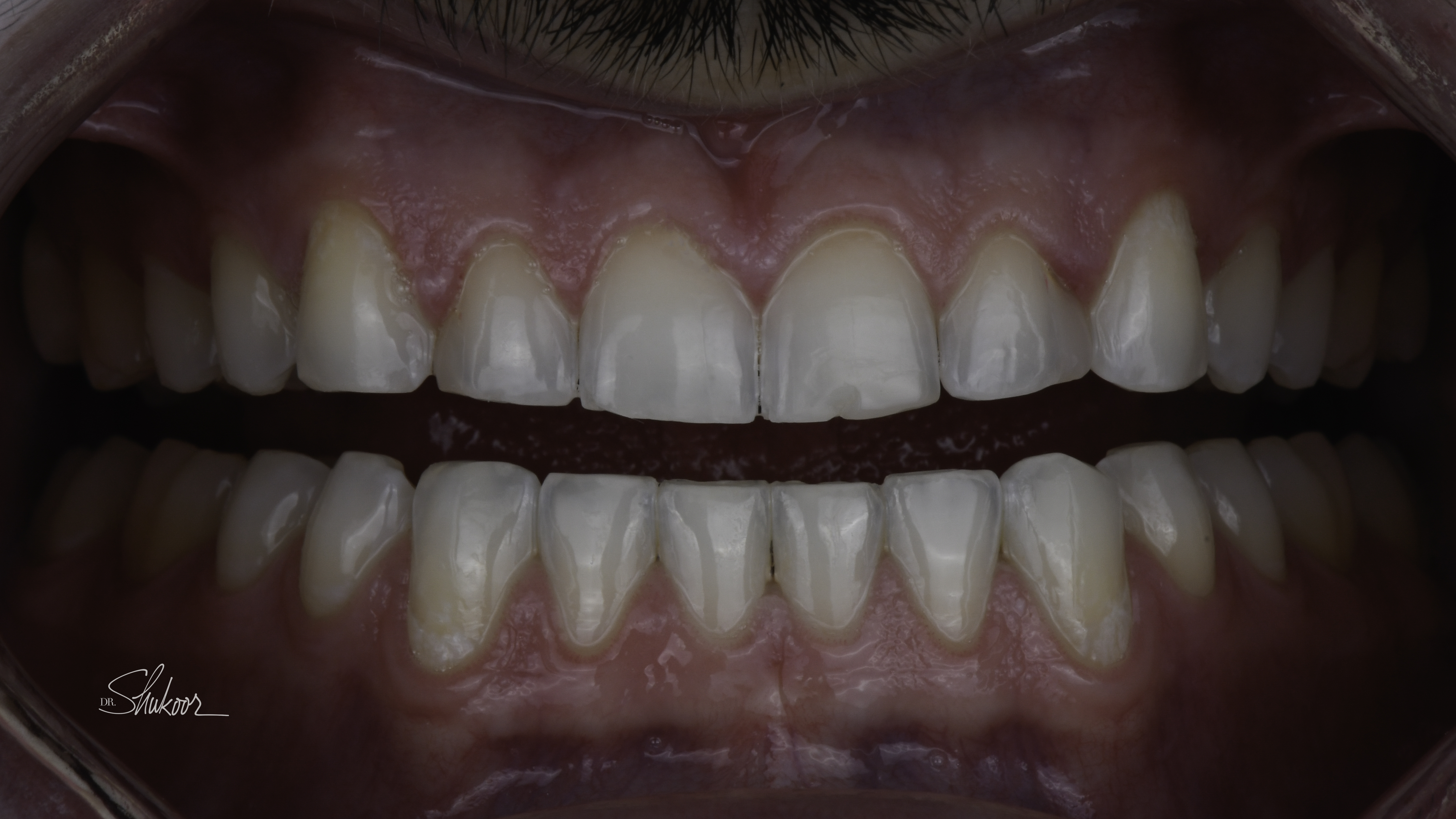Retracted view — porcelain veneers before and after, Worn & Uneven Front Teeth Rebuilt With Porcelain Veneers, Washington, DC — before treatment