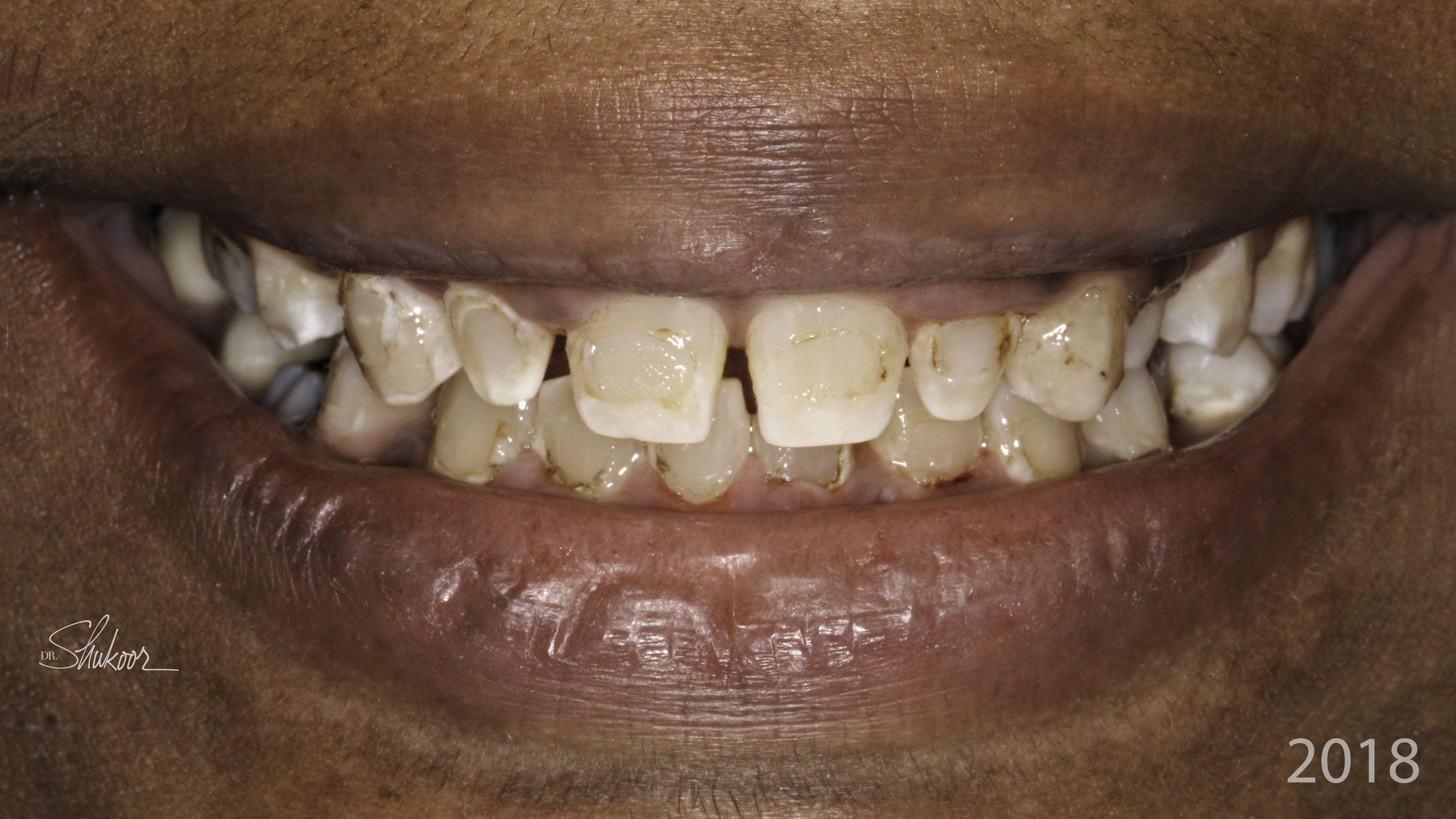 Smile makeover before and after — Complete smile makeover for a brighter, balanced smile, treated by Dr. Kambez Shukoor in Washington, DC — before treatment