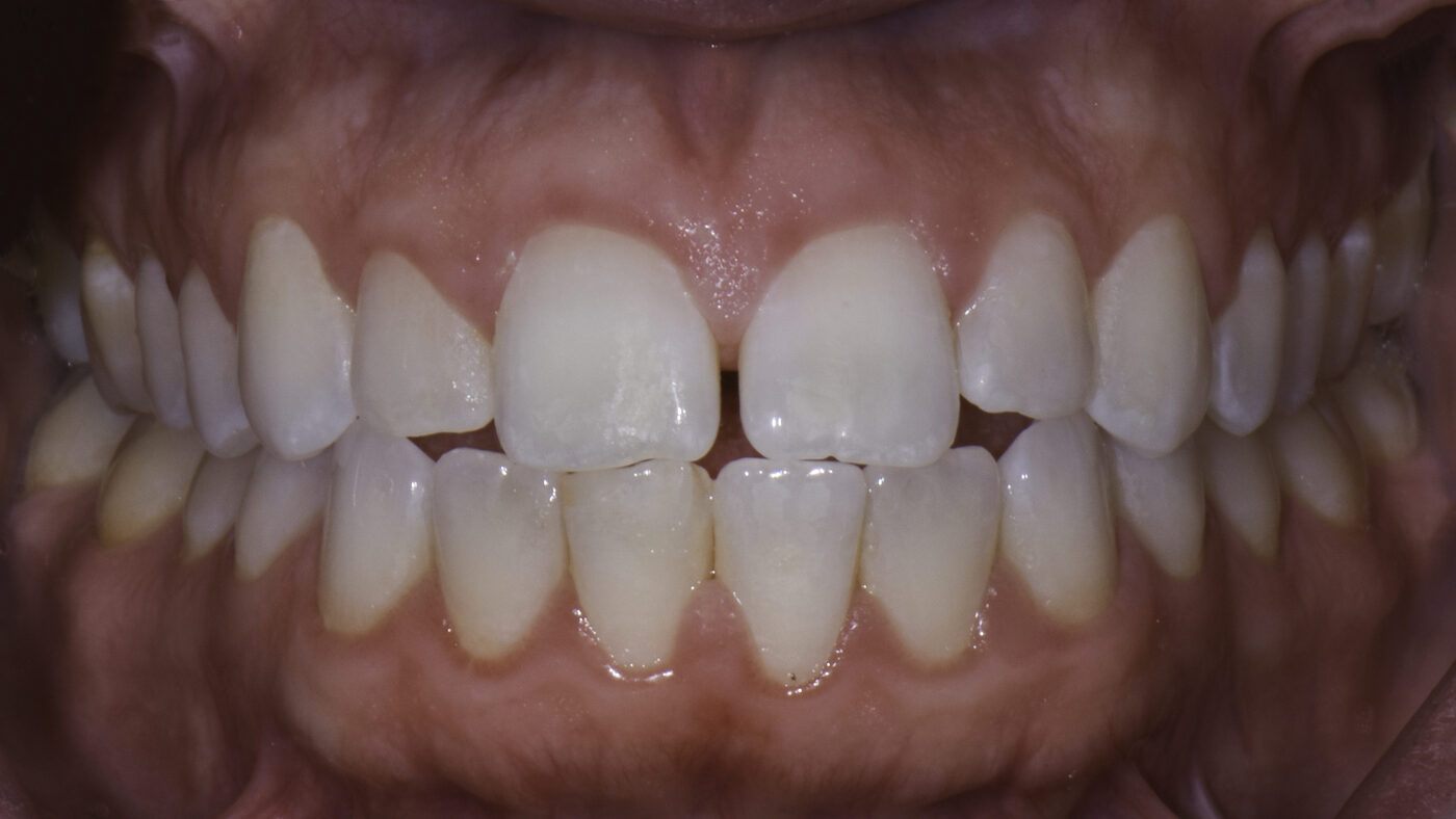 Clear Aligners case — Uneven spacing and rotation corrected with clear aligners, treated by Dr. Kambez Shukoor in Washington, DC — before treatment