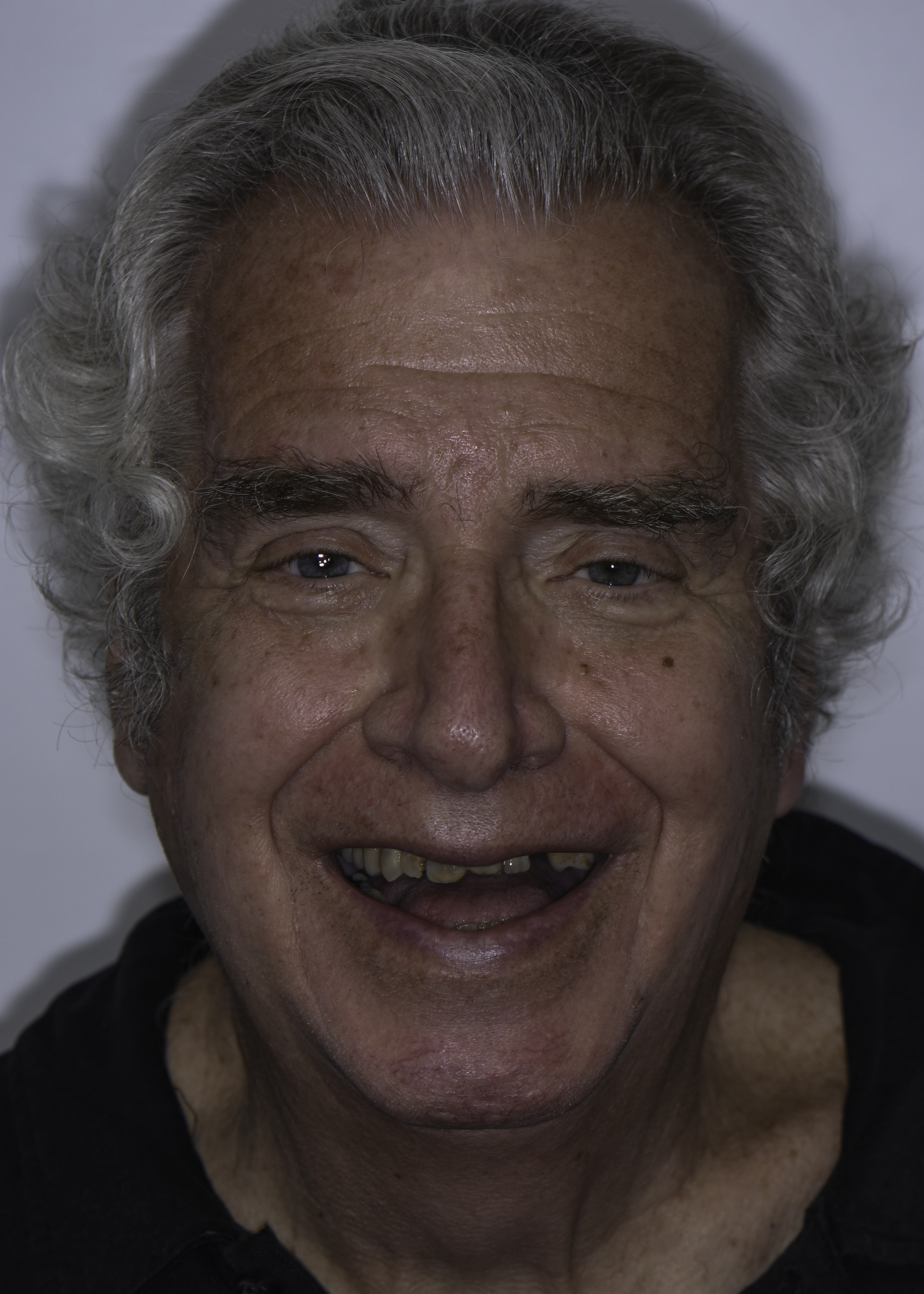 Full-arch implant before and after — Advanced periodontal breakdown treated with full-arch implants, treated by Dr. Kambez Shukoor in Washington, DC — before treatment