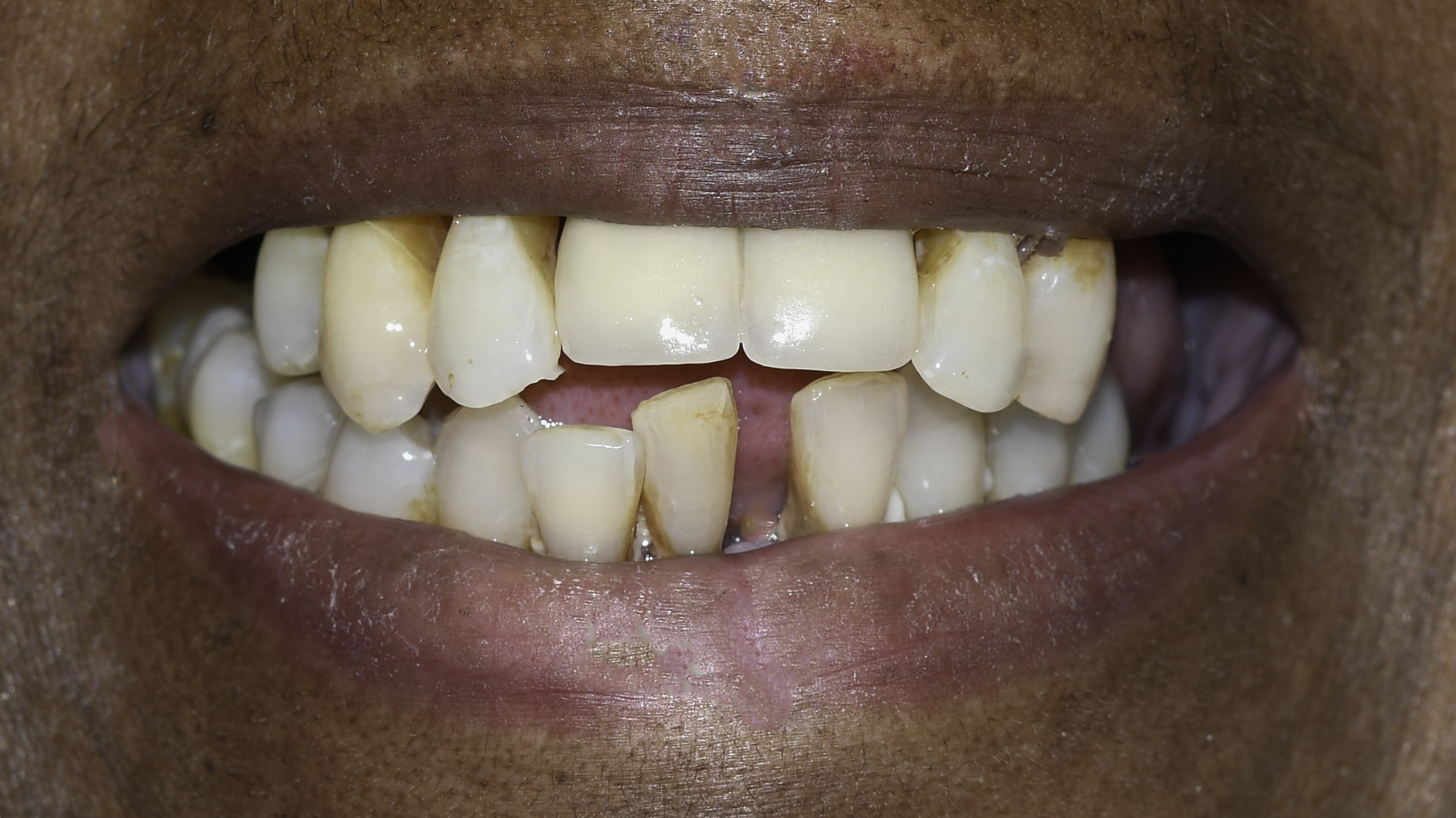 Full-arch implant before and after — Failing upper teeth replaced with a fixed implant-supported arch, treated by Dr. Kambez Shukoor in Washington, DC — before treatment