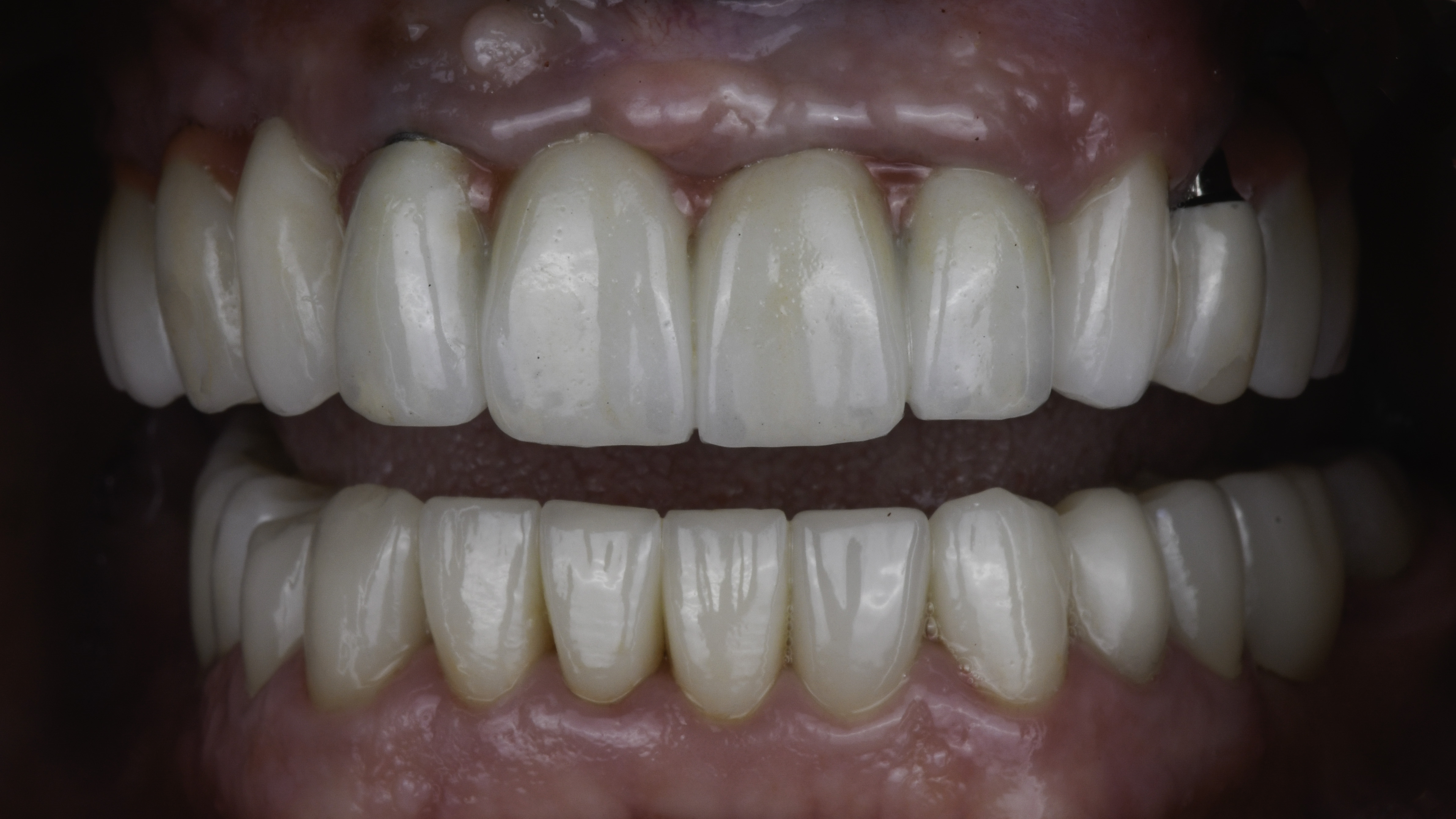 Close-up view — Smile makeover before and after, Worn, mismatched restorations rebuilt in a full-mouth rehabilitation, Washington, DC — after treatment