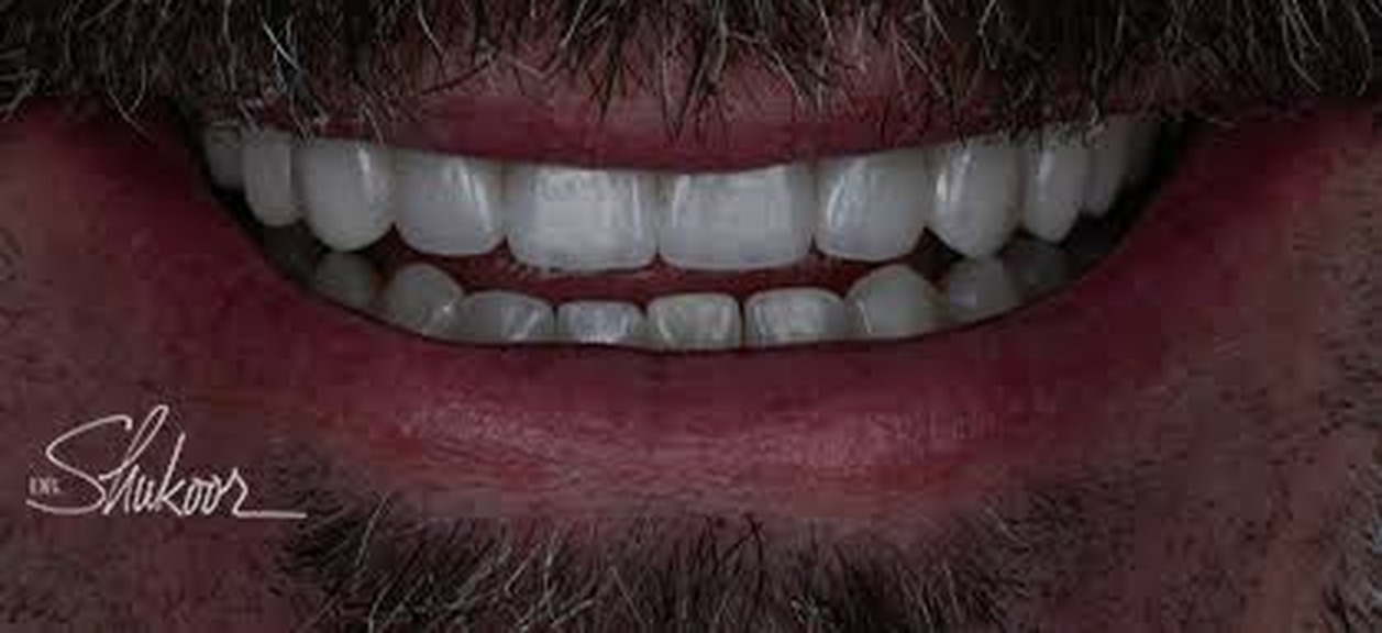 Single missing tooth restored with a dental implant and ceramic crown in Washington, DC — after treatment