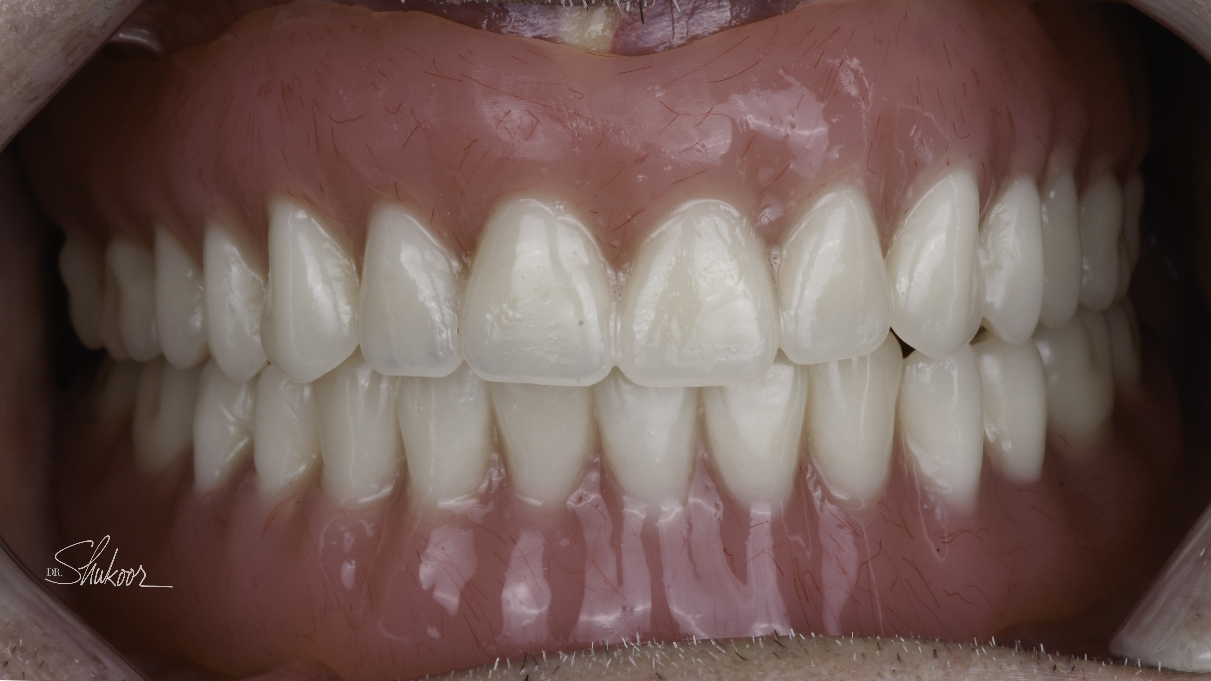Dentures case, close-up view — Full dentures restore a complete smile and comfortable bite, treated by Dr. Kambez Shukoor in Washington, DC — after treatment