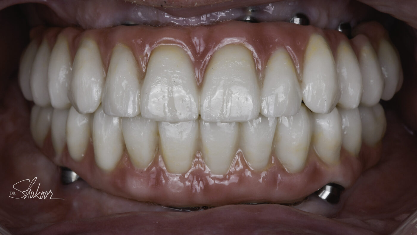 Full-Arch Implants case — Advanced periodontal breakdown treated with full-arch implants, treated by Dr. Kambez Shukoor in Washington, DC — after treatment