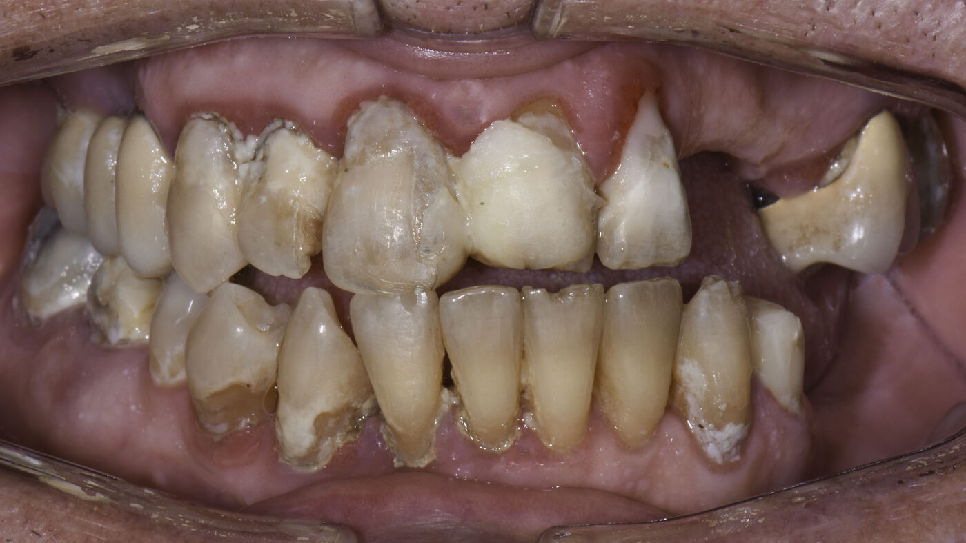 Full-Arch Implants case — Advanced periodontal breakdown treated with full-arch implants, treated by Dr. Kambez Shukoor in Washington, DC — before treatment