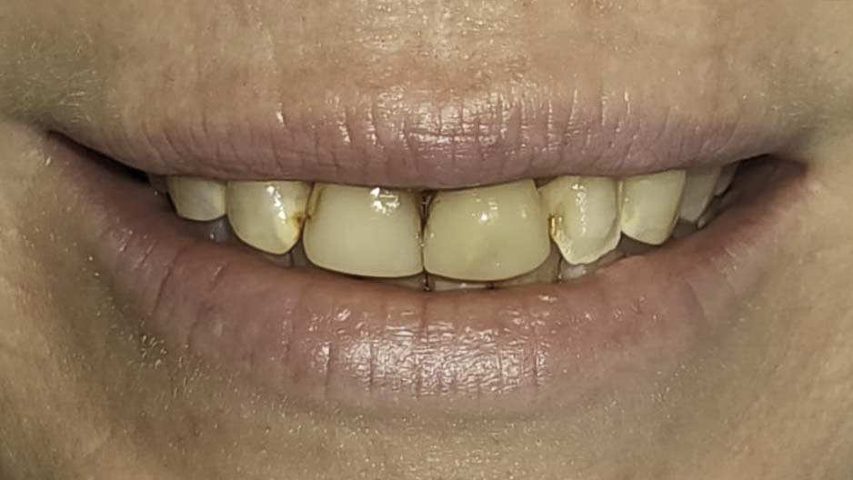 Porcelain veneers before and after — Stained, Chipped Teeth Transformed With Porcelain Veneers, treated by Dr. Kambez Shukoor in Washington, DC — before treatment