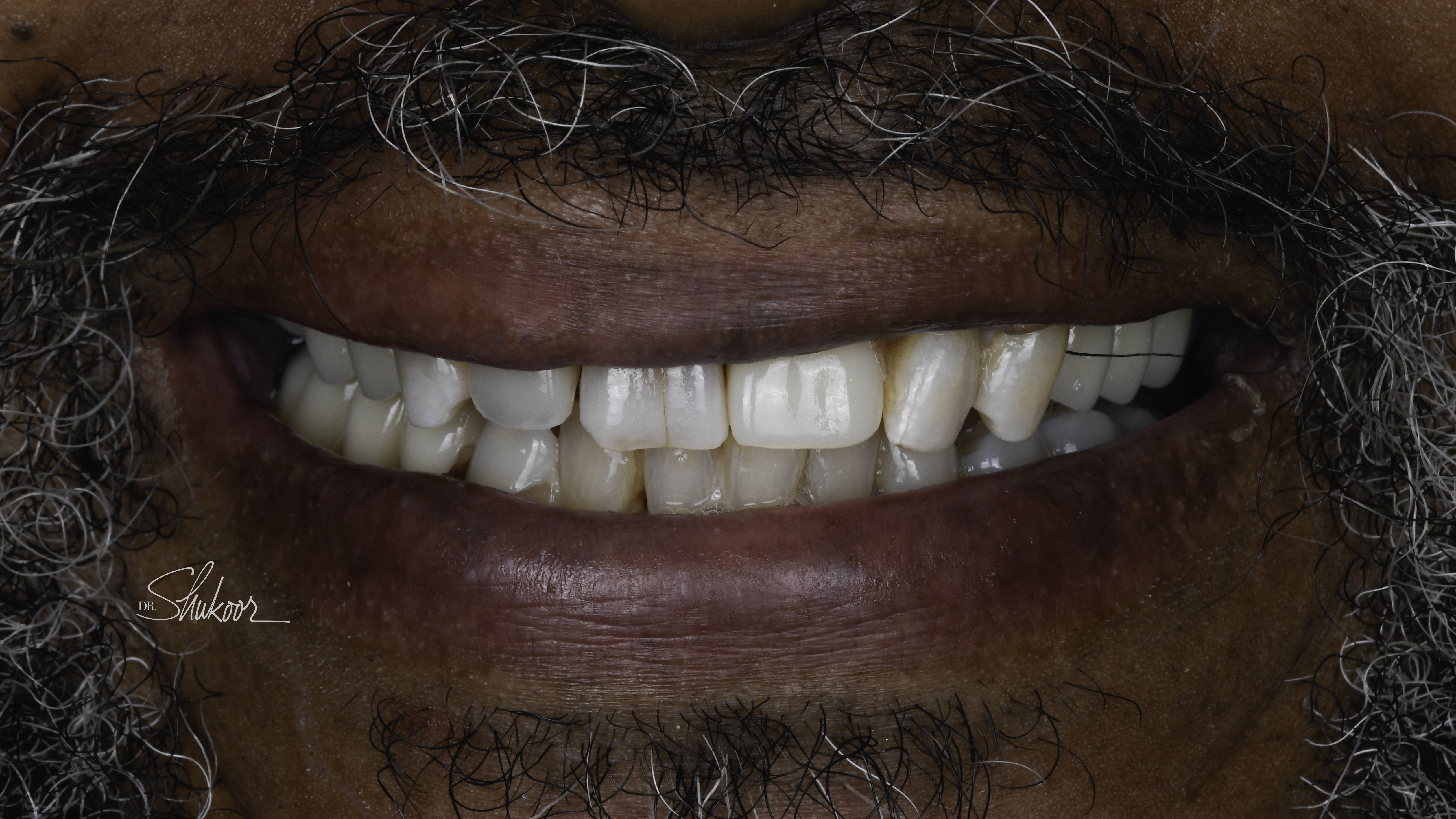 Dental Flipper case — Missing front tooth replaced immediately with a dental flipper, treated by Dr. Kambez Shukoor in Washington, DC — after treatment