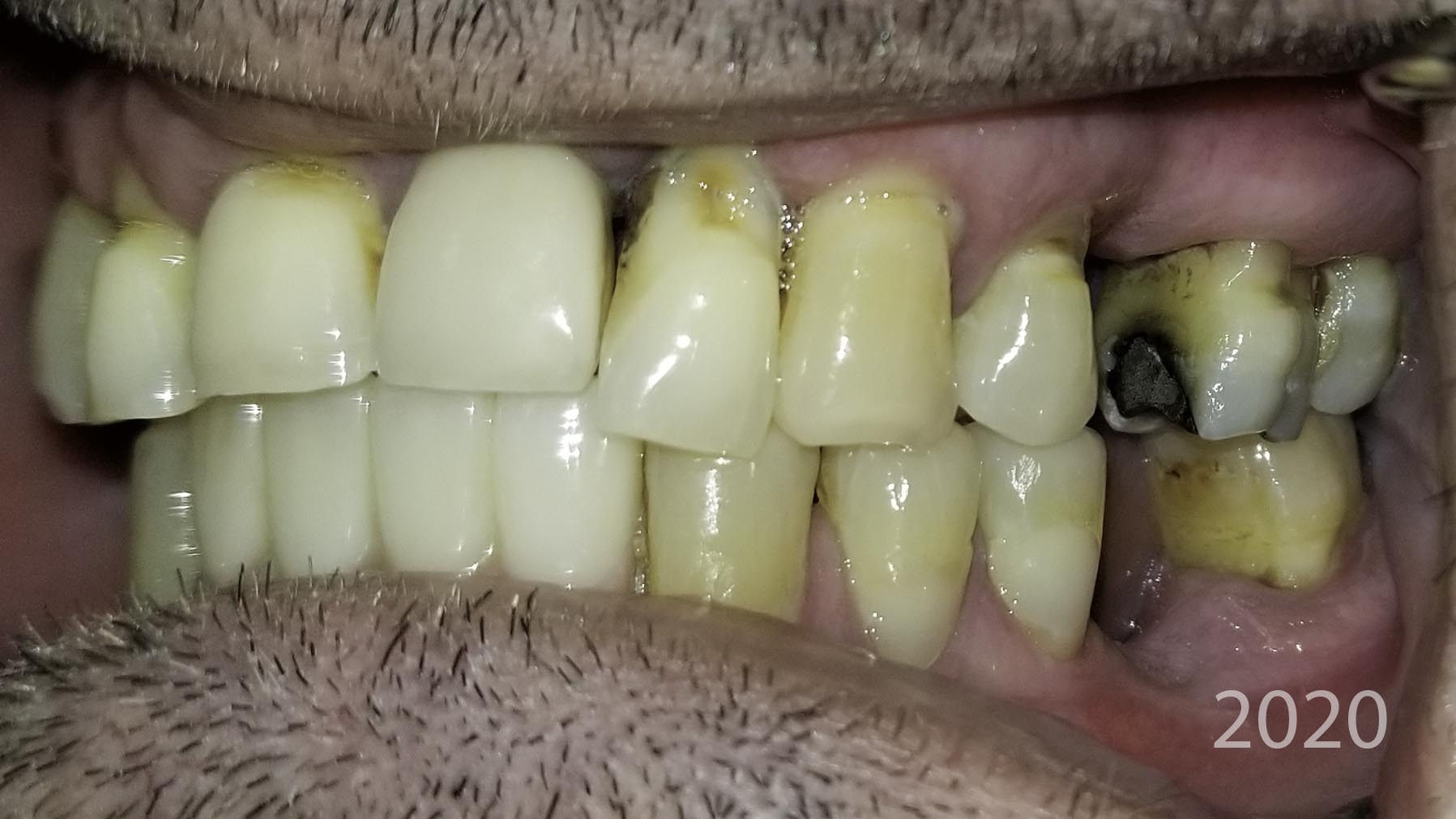 Close-up view — Full-arch implant before and after, Worn, discolored dentition restored with full-arch implants, Washington, DC — before treatment