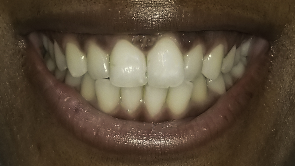 Clear aligners before and after — Crowded upper and lower front teeth aligned with clear aligners, treated by Dr. Kambez Shukoor in Washington, DC — before treatment