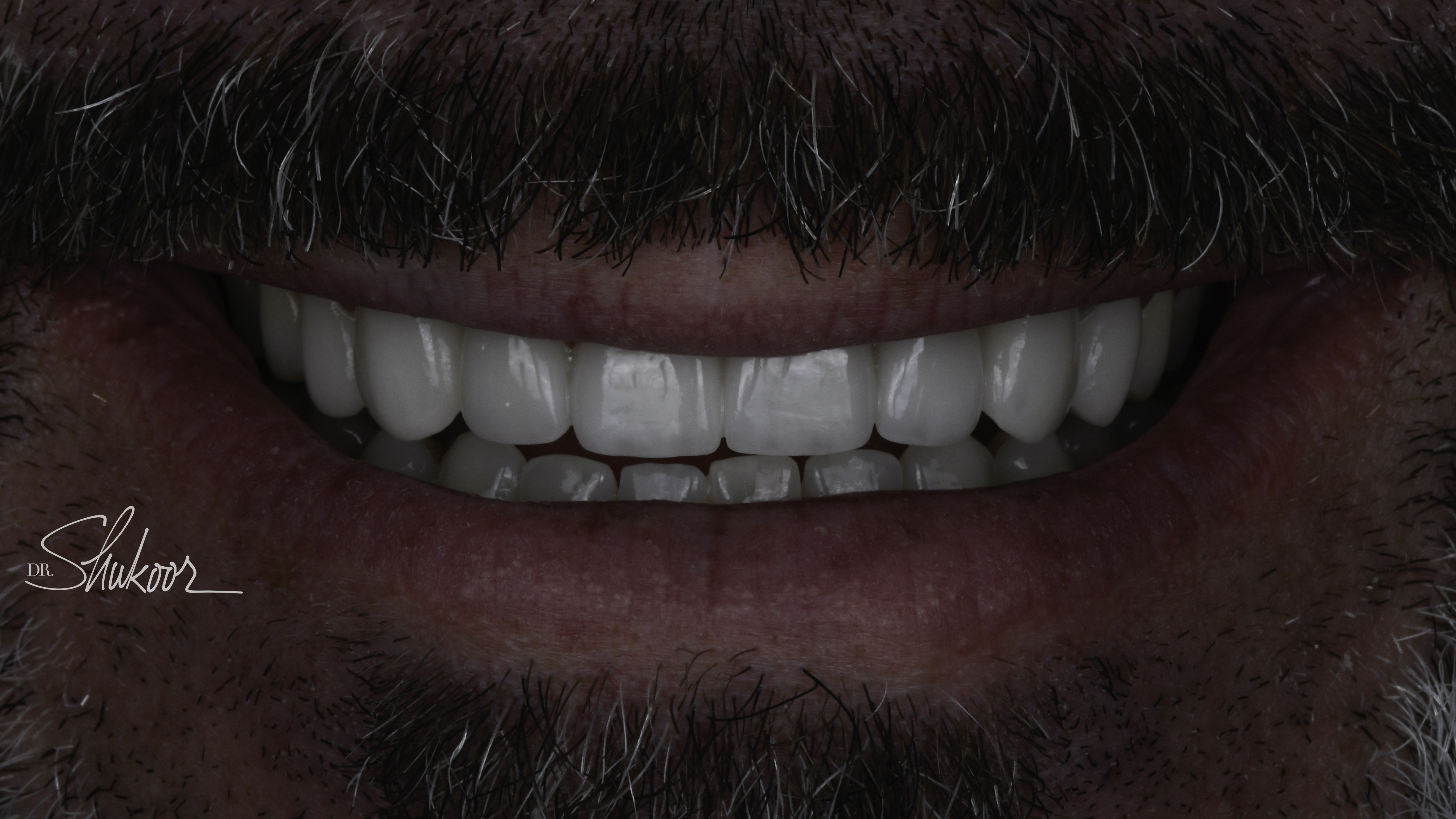 Smile makeover before and after — Worn, discolored smile rebuilt with a complete smile makeover, treated by Dr. Kambez Shukoor in Washington, DC — after treatment