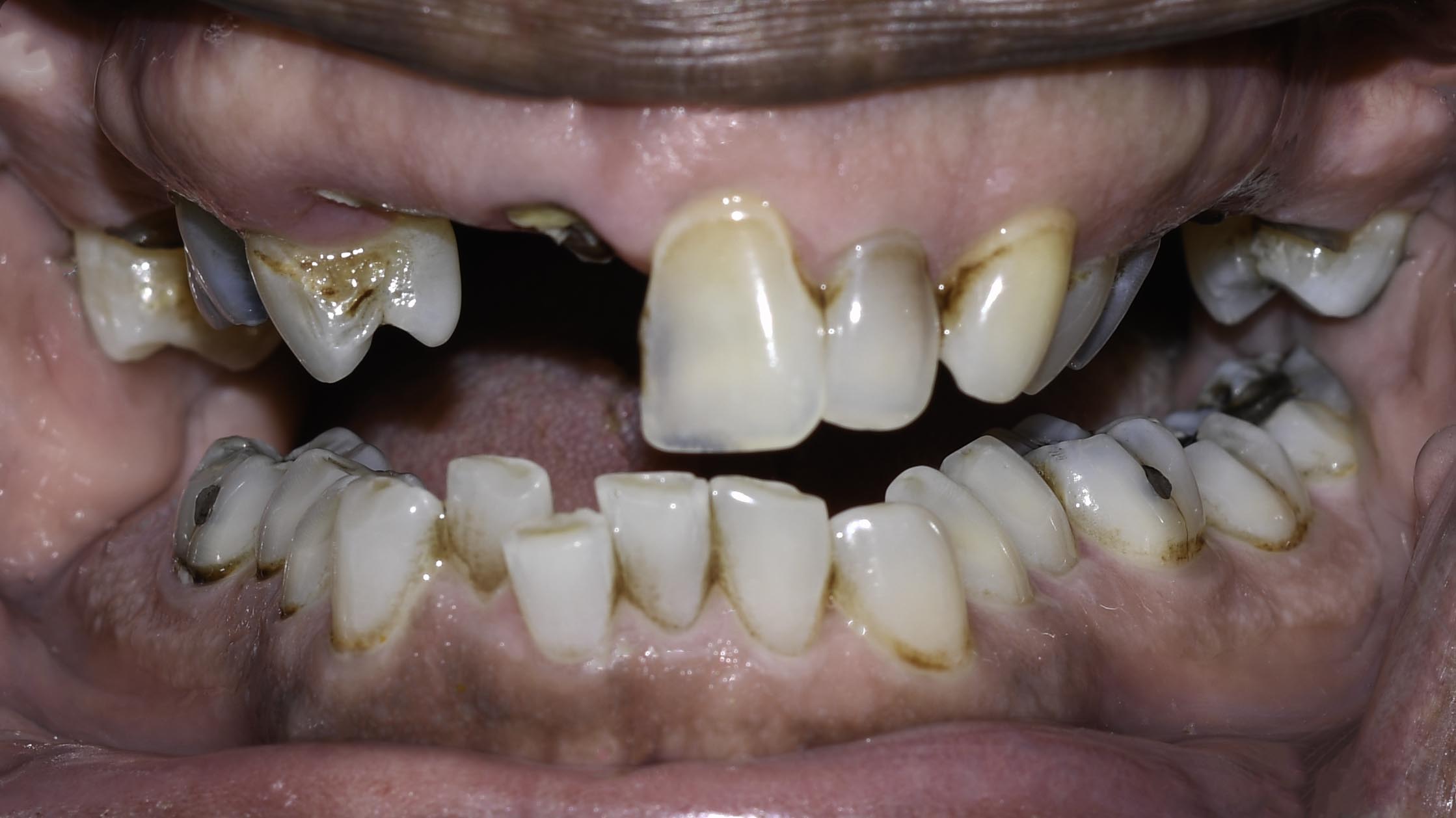 Retracted view — Full-arch implant before and after, Broken-down teeth rebuilt with full-arch implant restoration, Washington, DC — before treatment
