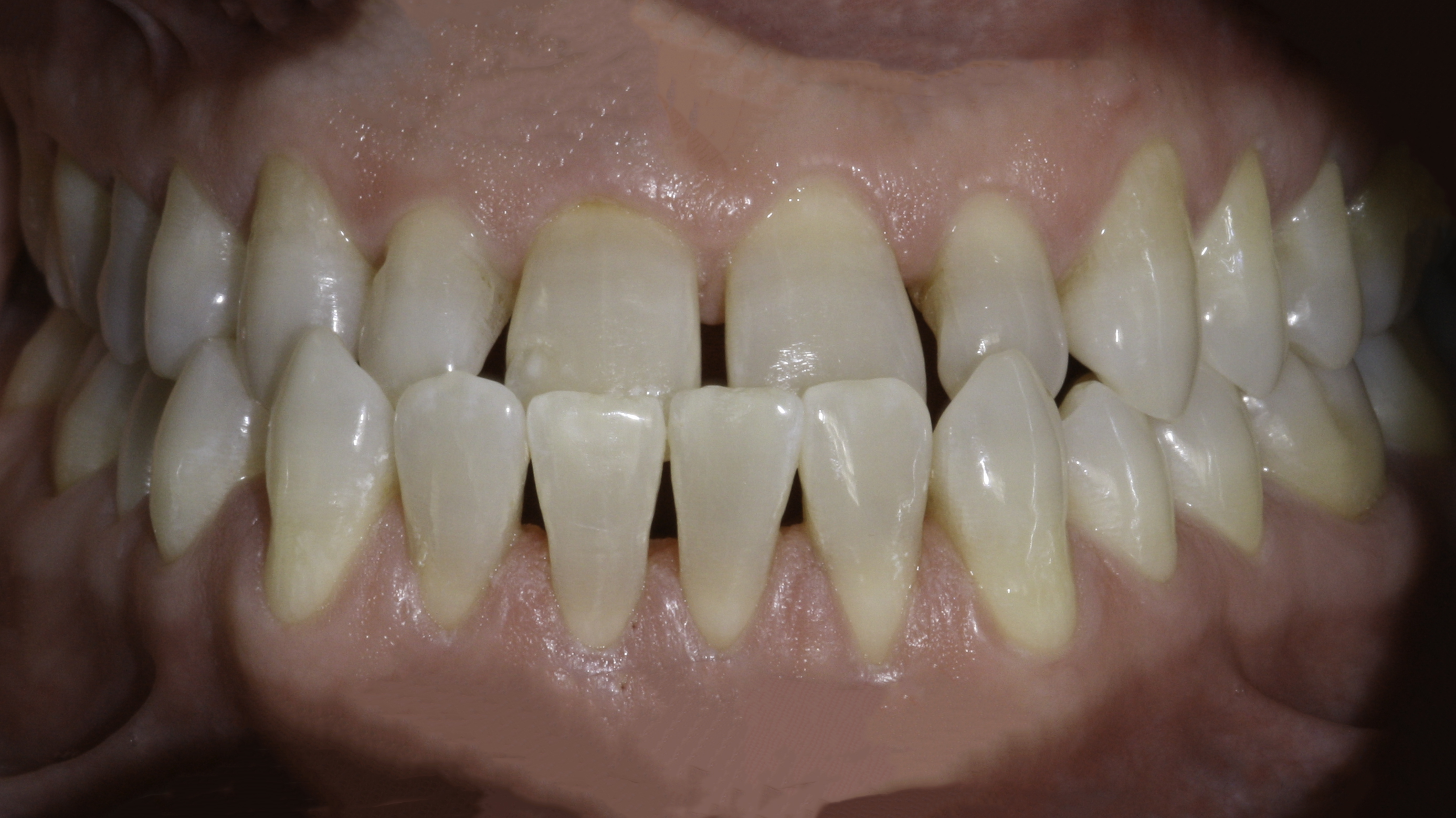 Porcelain veneers before and after — Narrow, Spaced Teeth Reshaped With a Full Veneer Smile, treated by Dr. Kambez Shukoor in Washington, DC — before treatment