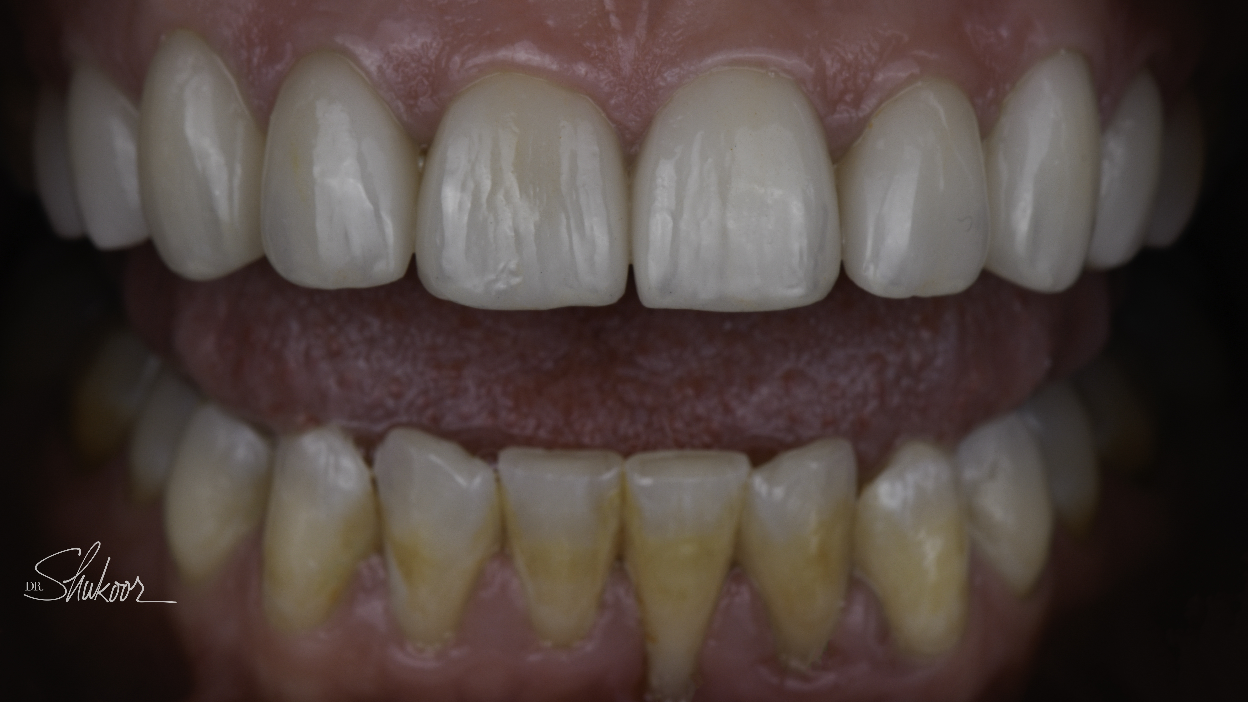 Retracted view — porcelain veneers before and after, Stained, Chipped Teeth Transformed With Porcelain Veneers, Washington, DC — after treatment