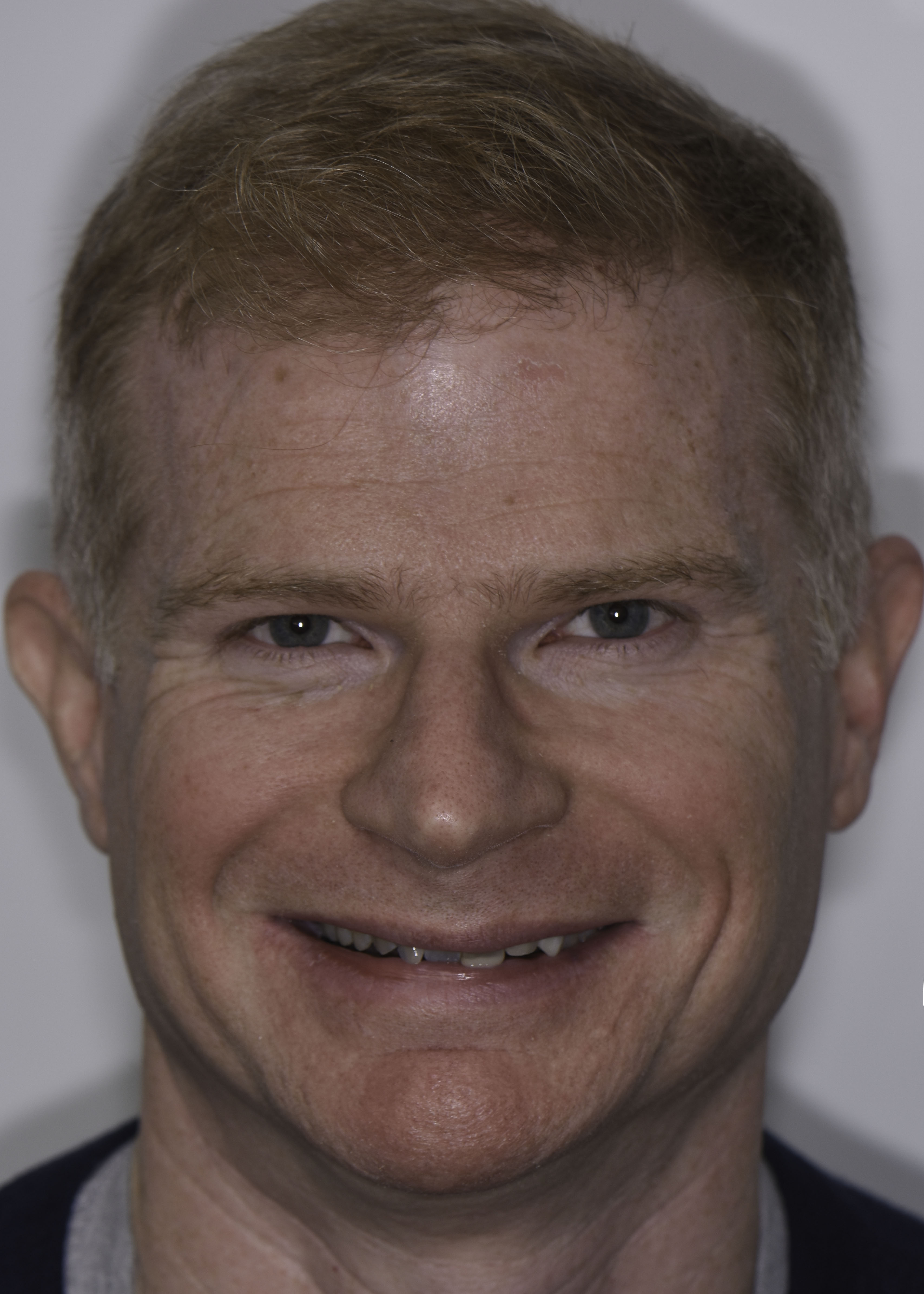 Smile makeover before and after — Damaged and discolored teeth renewed with full-mouth rehabilitation, treated by Dr. Kambez Shukoor in Washington, DC — before treatment