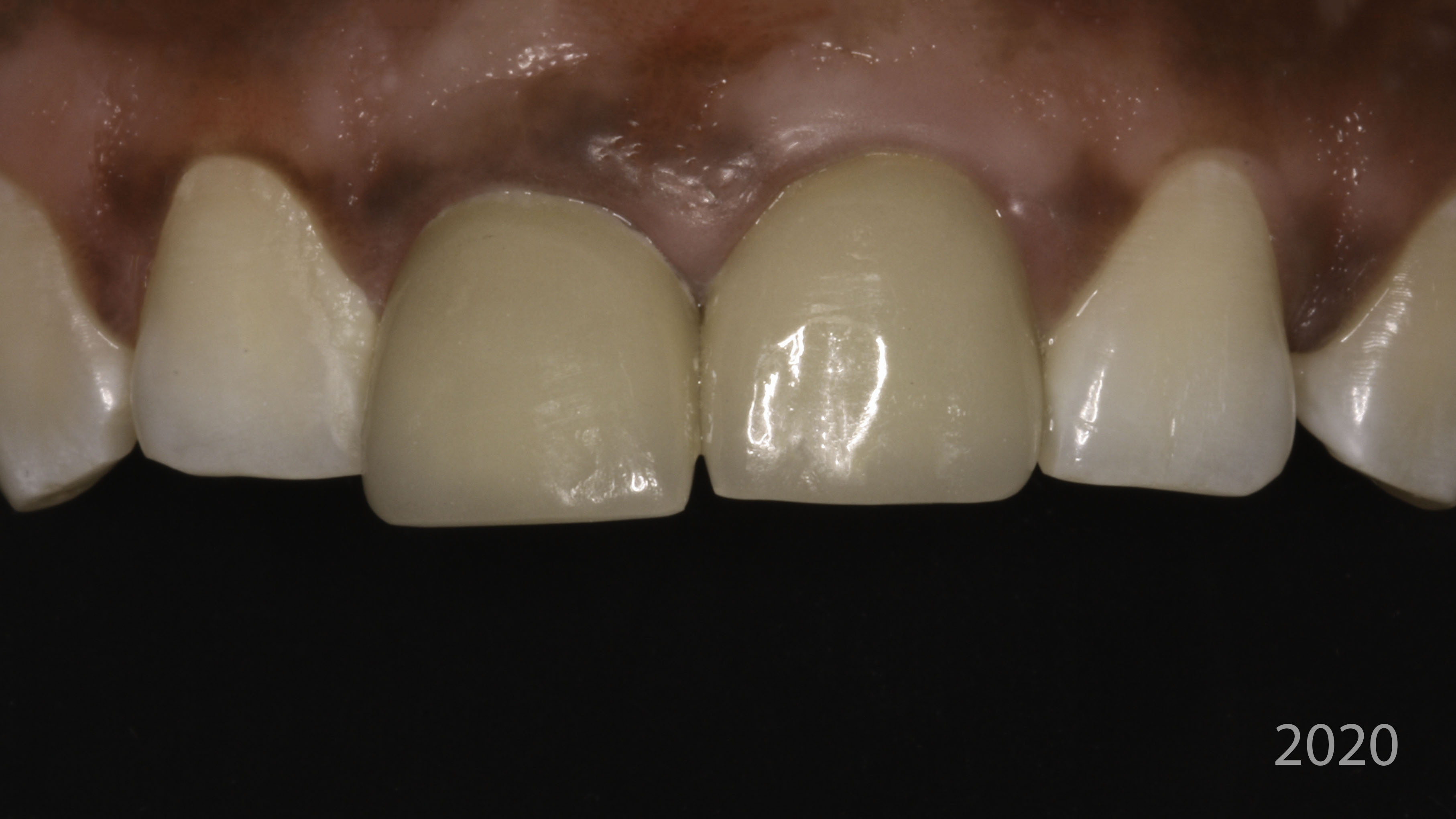 Close-up view — Full-arch implant before and after, Worn, discolored front teeth restored with implant crowns, Washington, DC — before treatment
