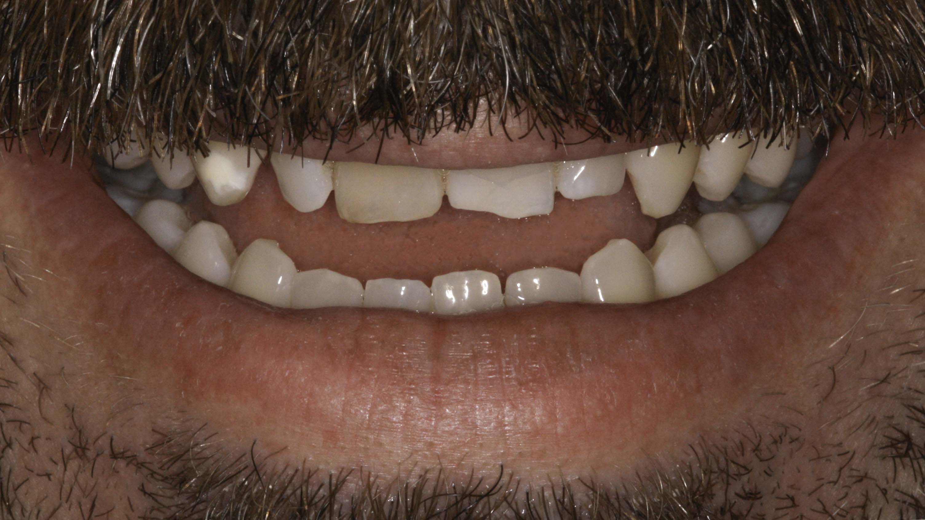 Smile makeover before and after — Worn, discolored smile rebuilt with a complete smile makeover, treated by Dr. Kambez Shukoor in Washington, DC — before treatment