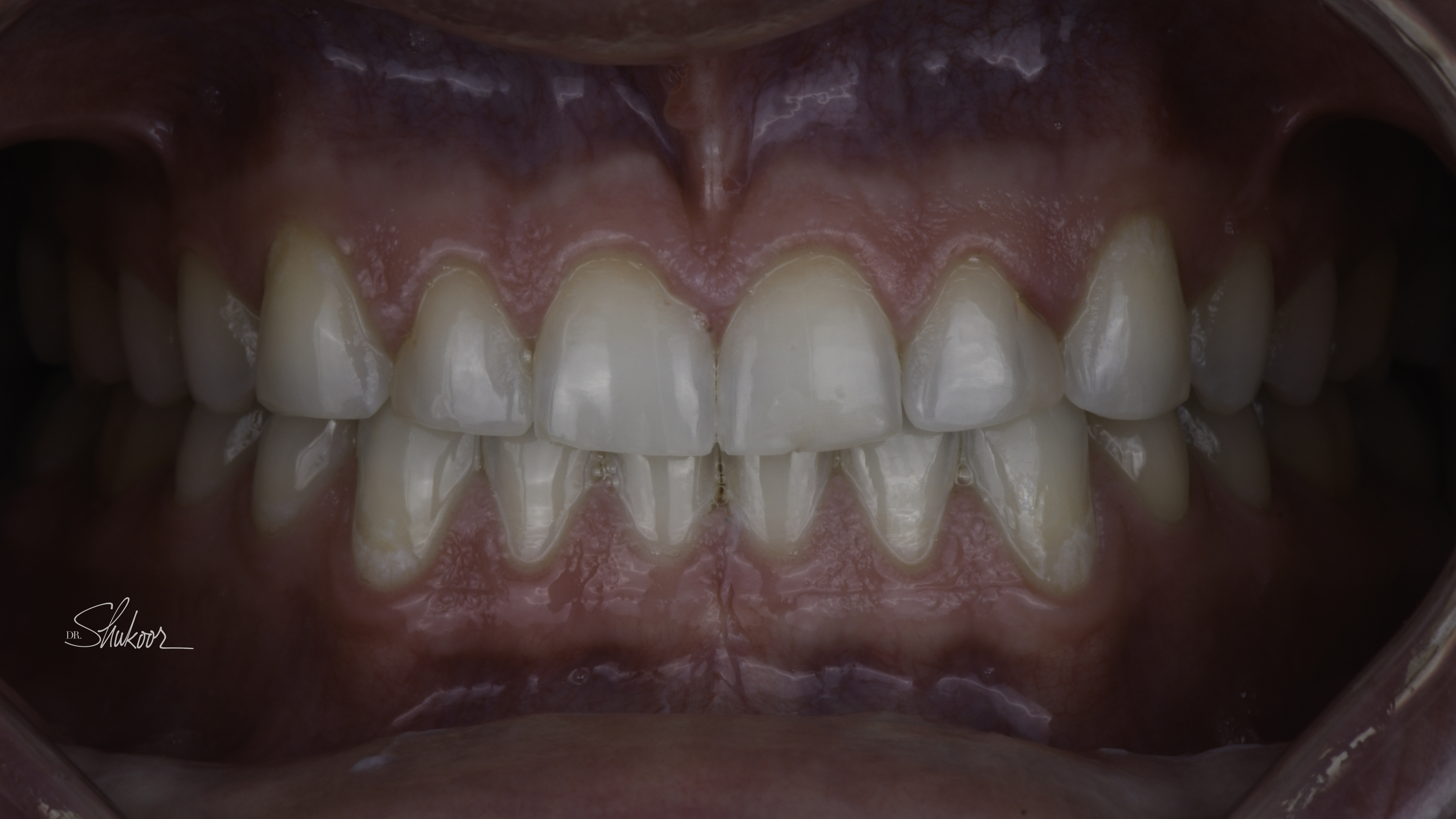 Close-up view — porcelain veneers before and after, Worn & Uneven Front Teeth Rebuilt With Porcelain Veneers, Washington, DC — before treatment