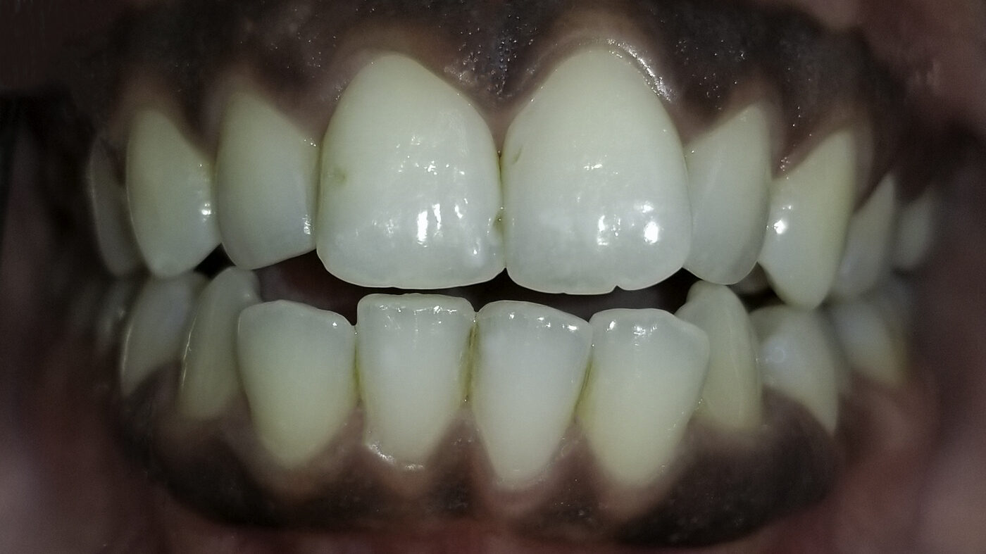 Clear Aligners case — Crowded upper and lower front teeth aligned with clear aligners, treated by Dr. Kambez Shukoor in Washington, DC — before treatment
