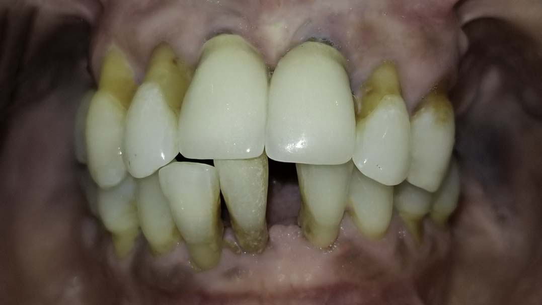 Smile view — Full-arch implant before and after, Failing upper teeth replaced with a fixed implant-supported arch, Washington, DC — before treatment