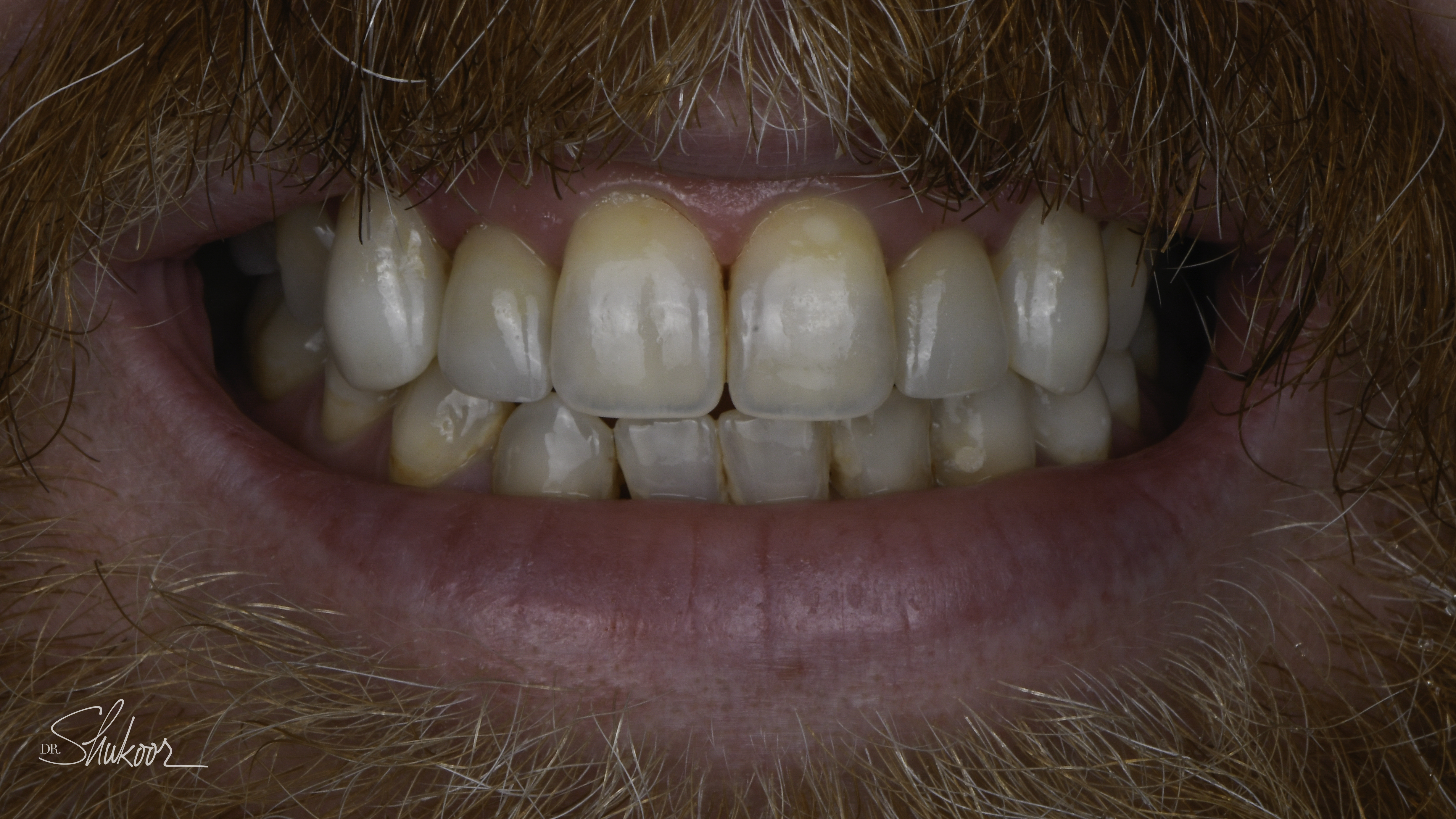 Close-up view — Smile makeover before and after, Smile makeover restores symmetry and a healthy shade, Washington, DC — after treatment