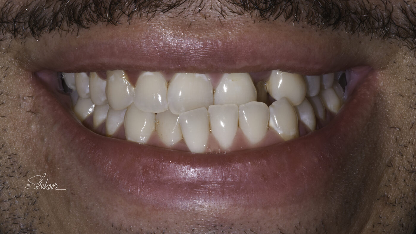 Clear Aligners case — Crowded arch expanded and leveled with clear aligners, treated by Dr. Kambez Shukoor in Washington, DC — before treatment