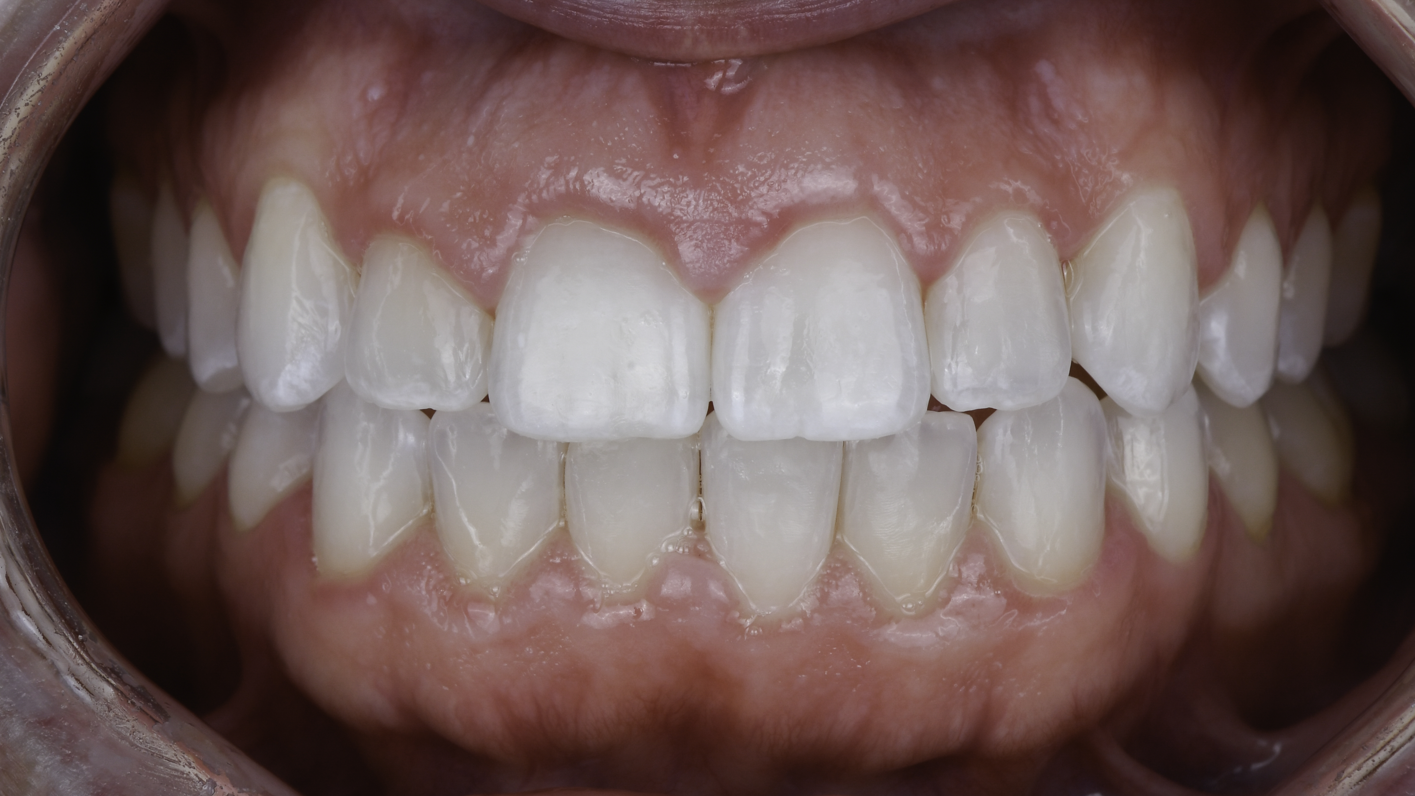 Clear aligners before and after, close-up view — Uneven spacing and rotation corrected with clear aligners, treated by Dr. Kambez Shukoor in Washington, DC — after treatment
