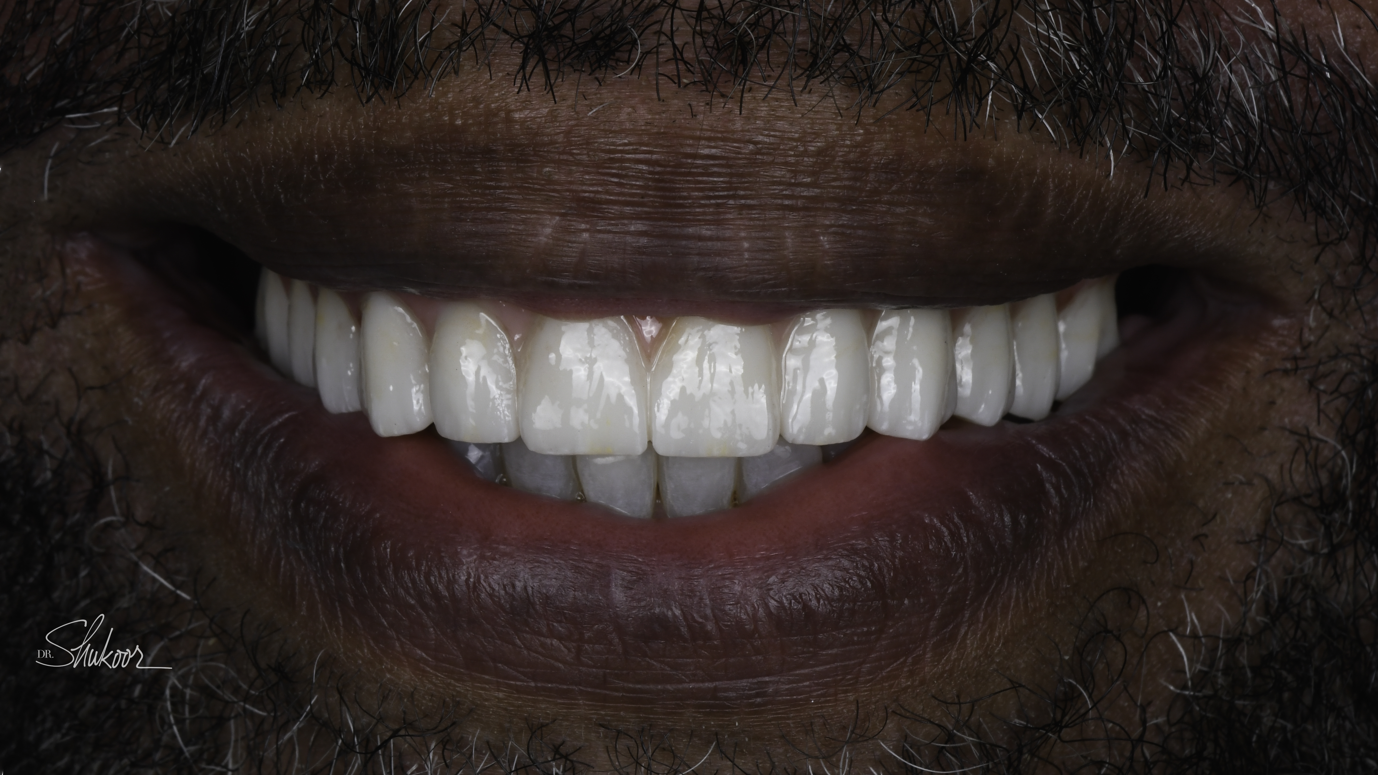 Close-up view — Full-arch implant before and after, Broken-down teeth rebuilt with full-arch implant restoration, Washington, DC — after treatment