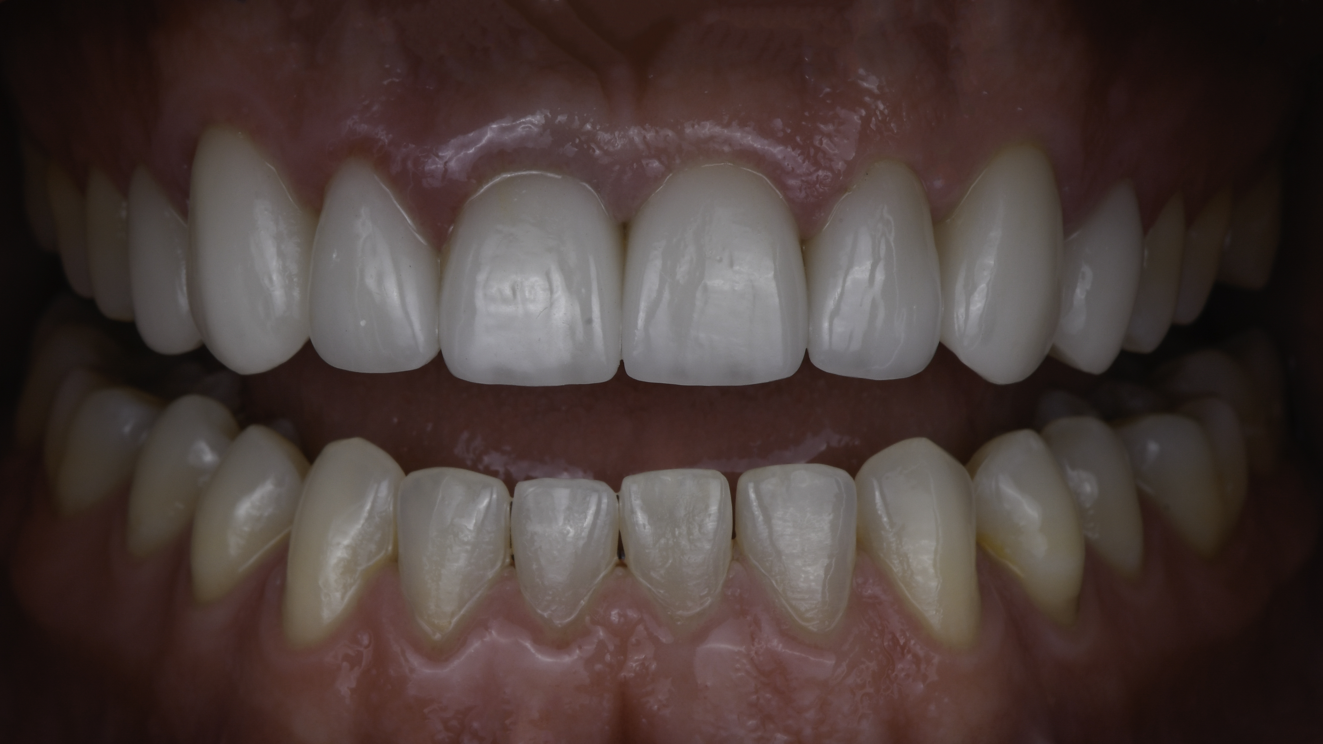 Retracted view — Smile makeover before and after, Worn, discolored smile rebuilt with a complete smile makeover, Washington, DC — after treatment