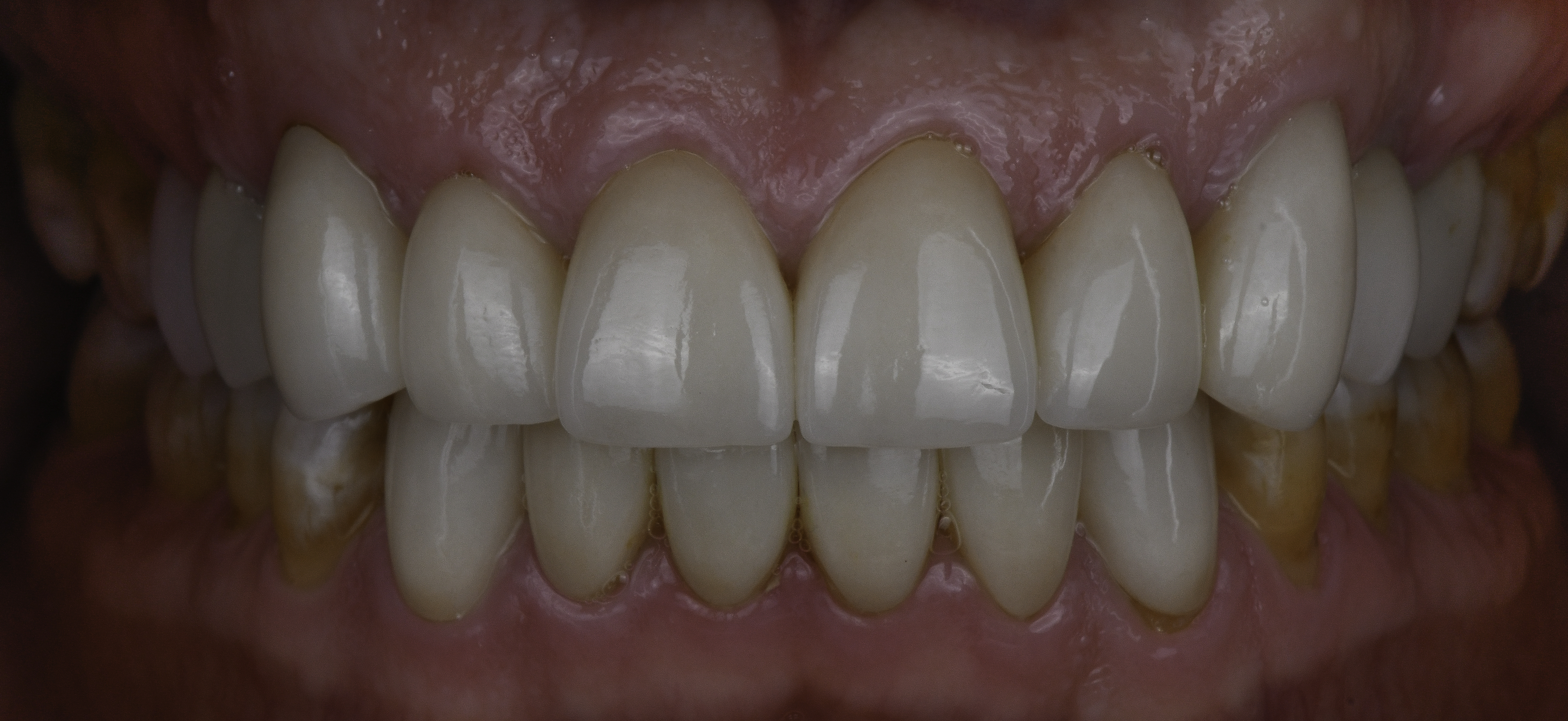 Retracted view — Smile makeover before and after, Smile makeover brightens and evens worn front teeth, Washington, DC — after treatment