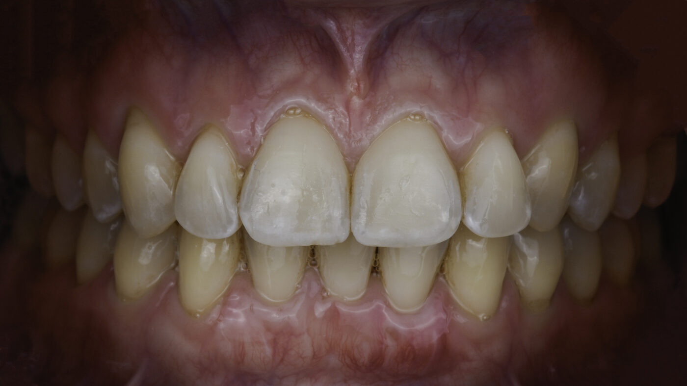 Clear Aligners case — Overlapping front teeth straightened with clear aligner therapy, treated by Dr. Kambez Shukoor in Washington, DC — after treatment