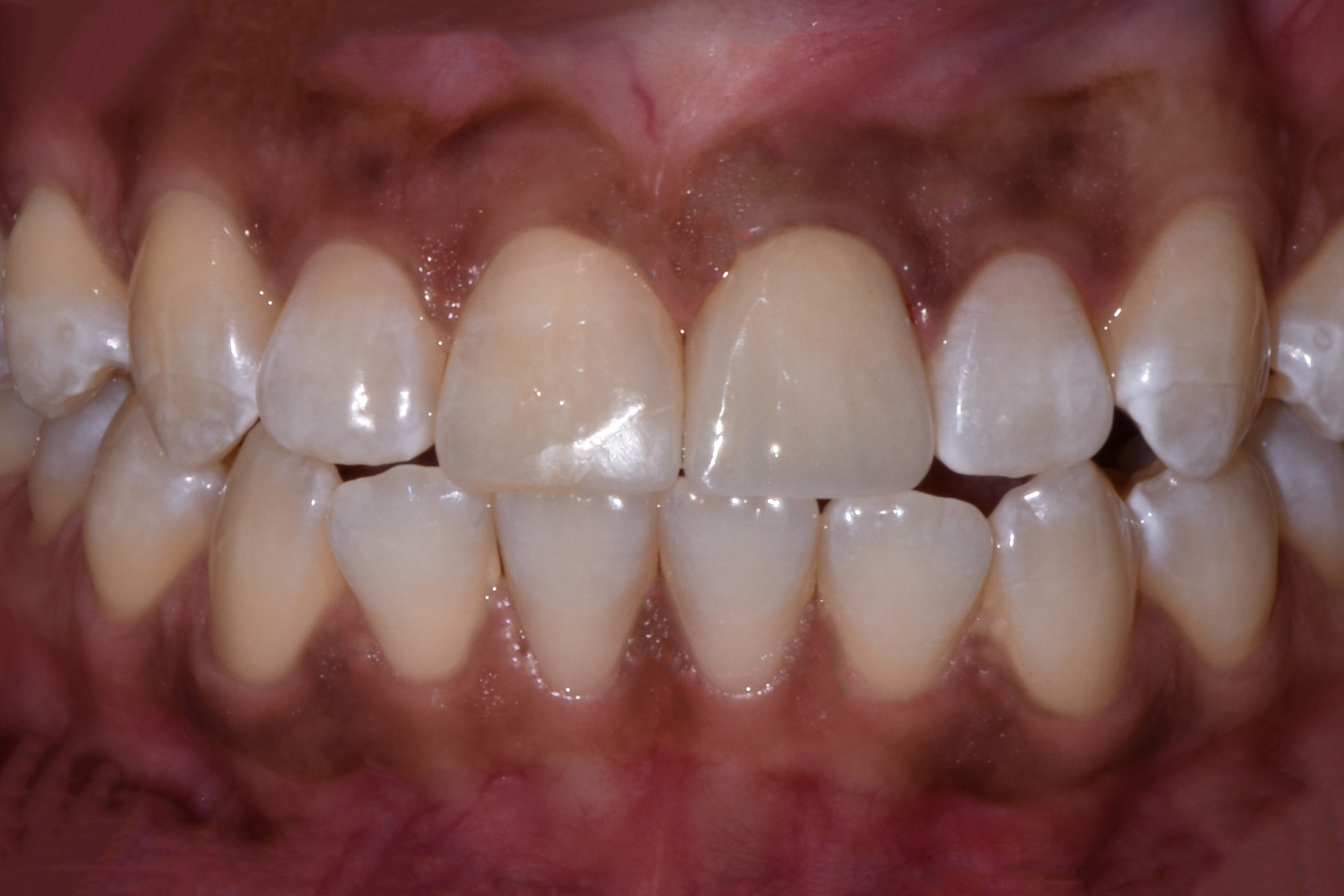 Dental Bonding before and after result — Chipped and worn upper front teeth rebuilt with composite bonding, treated by Dr. Kambez Shukoor in Washington, DC — after treatment