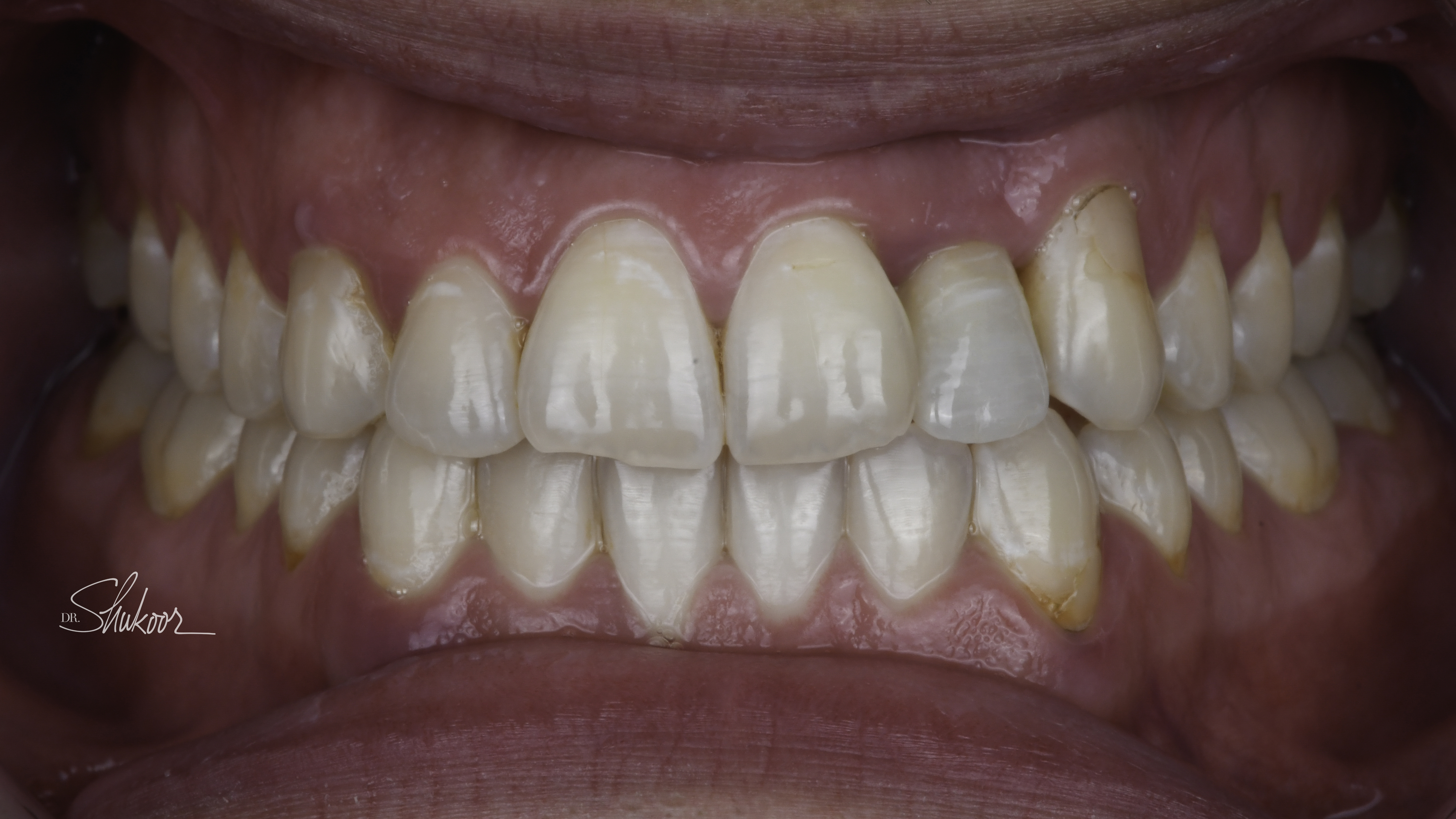 Clear aligners before and after — Crowded arch expanded and leveled with clear aligners, treated by Dr. Kambez Shukoor in Washington, DC — after treatment