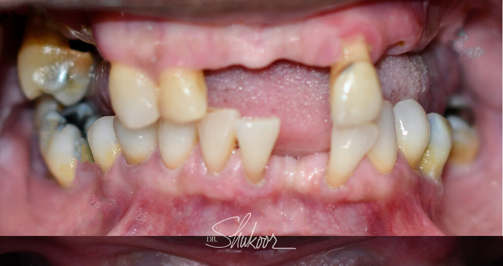 Full-Arch Implants case — Only a few remaining teeth replaced with fixed implant arches, treated by Dr. Kambez Shukoor in Washington, DC — after treatment