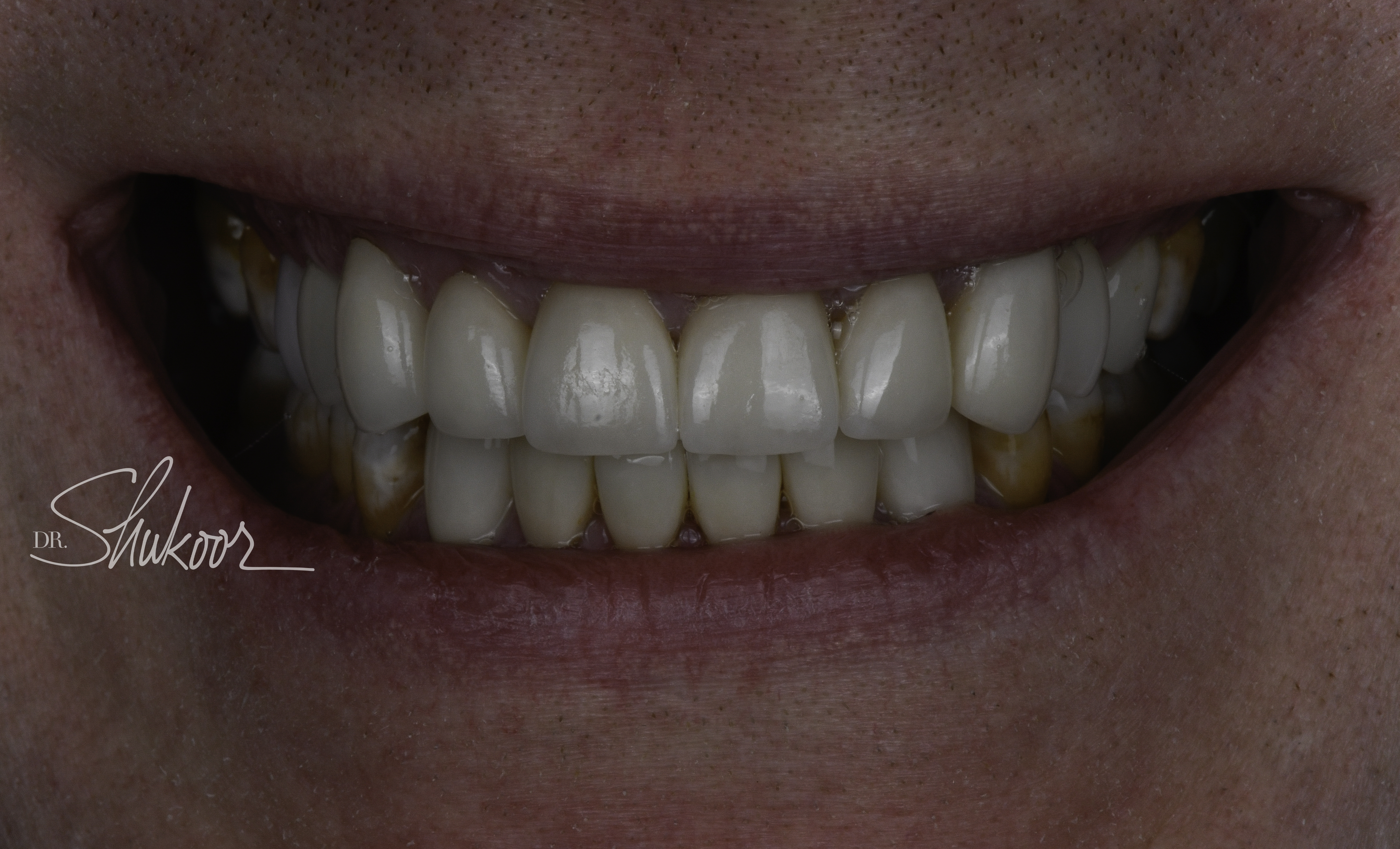 Smile makeover before and after — Smile makeover brightens and evens worn front teeth, treated by Dr. Kambez Shukoor in Washington, DC — after treatment