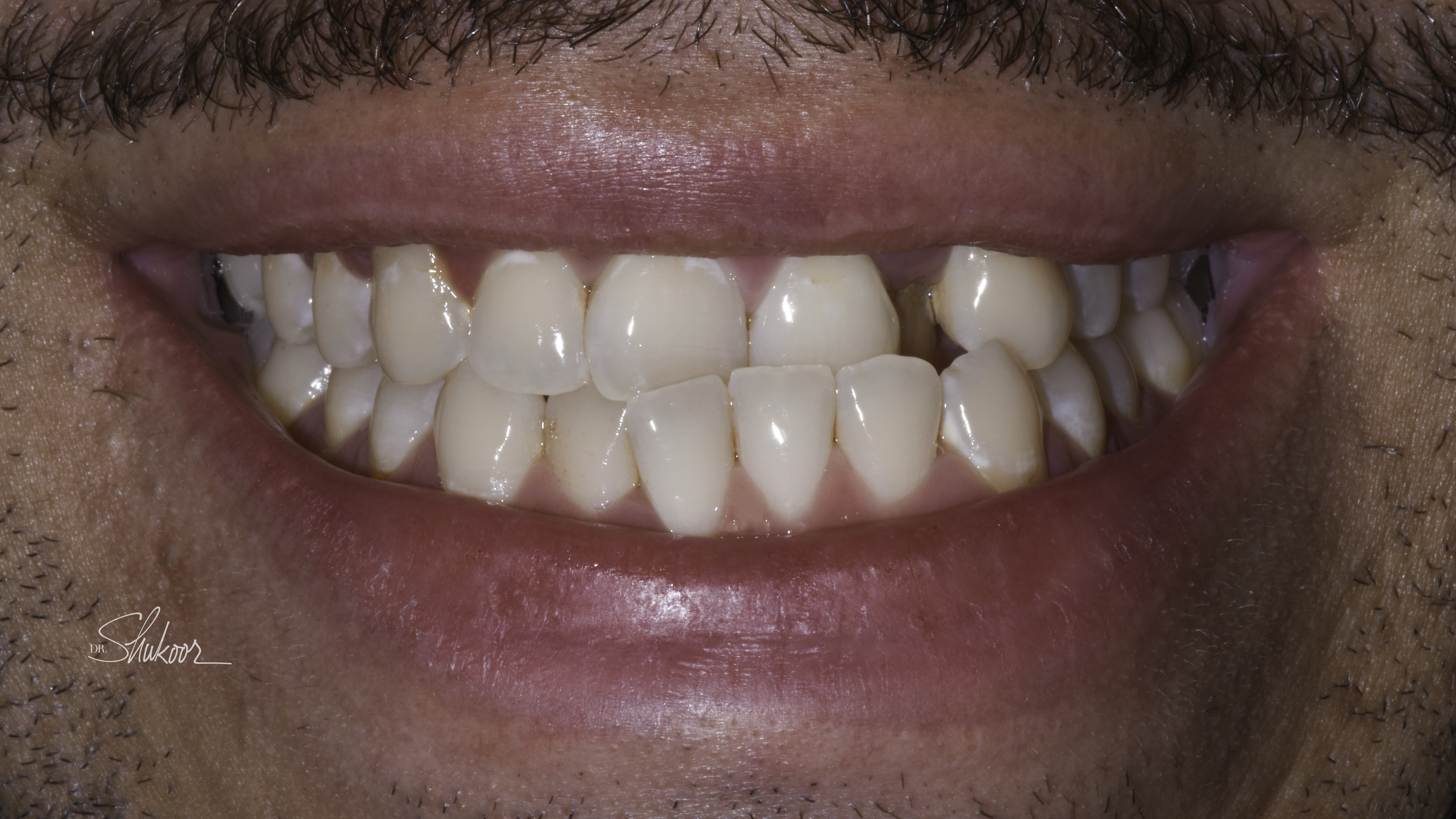 Clear aligners before and after — Crowded arch expanded and leveled with clear aligners, treated by Dr. Kambez Shukoor in Washington, DC — before treatment